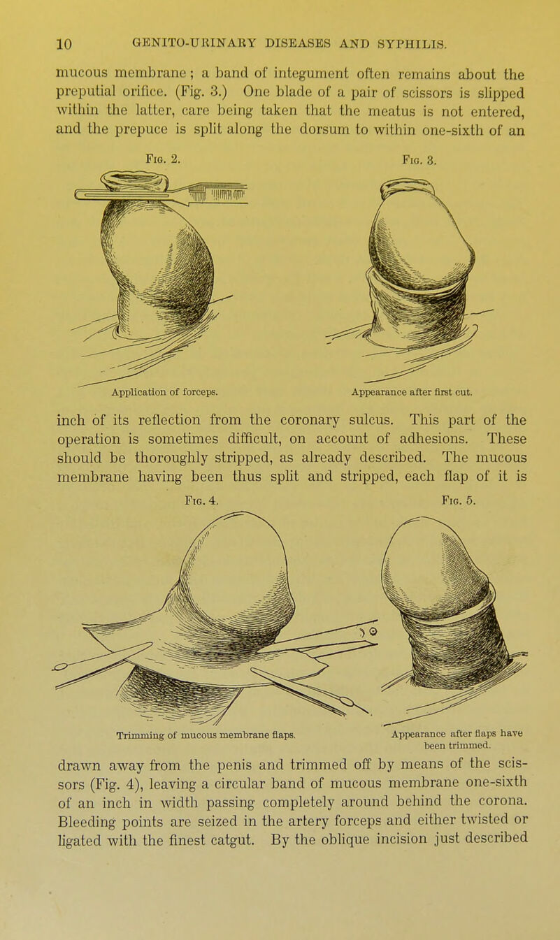 mucous membrane; a band of integument often remains about the preputial orifice. (Fig. 3.) One blade of a pair of scissors is slipped within the latter, care being taken that the meatus is not entered, and the prepuce is split along the dorsum to within one-sixth of an Fig. 2. Fig. 3. Application of forceps. Appearance after first cut. inch of its reflection from the coronary sulcus. This part of the operation is sometimes difficult, on account of adhesions. These should be thoroughly stripped, as already described. The mucous membrane having been thus split and stripped, each flap of it is Fig. 4, Fig. 5. Trimming of mucoiis membrane flaps. Appearance after flaps have been trimmed. drawn away from the penis and trimmed off by means of the scis- sors (Fig. 4), leaving a circular band of mucous membrane one-sixth of an inch in width passing completely around behind the corona. Bleeding points are seized in the artery forceps and either twisted or ligated with the finest catgut. By the oblique incision just described