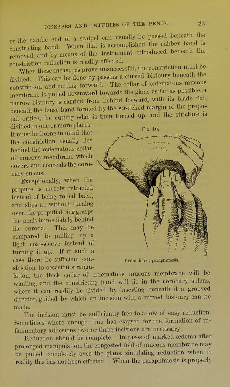 Fig. 10 or the handle end of a scalpel can usually be passed beneath the constricting band. When that is accomplished the rubber band is removed, and by means of the instrument introduced beneath the constriction reduction is readily effected. When these measures prove unsuccessful, the constriction must be divided This can be done by passing a curved bistoury beneath the constriction and cutting forward. The collar of oedematous mucous membrane is pulled downward towards the glans as far as Possible, a narrow bistoury is carried from behind forward, with its blade flat, beneath the tense band formed by the stretched margin of the prepu- tial orifice, the cutting edge is then turned up, and the stricture is divided in one or more places. It must be borne in mind that the constriction usually lies behind the oedematous collar of mucous membrane which covers and conceals the coro- nary sulcus. Exceptionally, when the prepuce is merely retracted instead of being rolled back, and slips up without turning over, the preputial ring grasps the peiiis immediately behind the corona. This may be compared to pulling up a tight coat-sleeve instead of turning it up. If in such a case there be sufficient con- striction to occasion strangu Reduction of paraphimosis. lation, the thick collar of oedematous mucous membrane will be wanting, and the constricting band will he in the coronary sulcus, where it can readily be divided by inserting beneath it a grooved director, guided by which an incision with a curved bistoury can be made. The incision must be sufficiently free to allow of easy reduction. Sometimes where enough time has elapsed for the formation of in- flammatory adhesions two or three incisions are necessary. Reduction should be complete. In cases of marked oedema after prolonged manipulation, the congested fold of mucous membrane may be pulled completely over the glans, simulating reduction when in reality this has not been effected. When the paraphimosis is properly