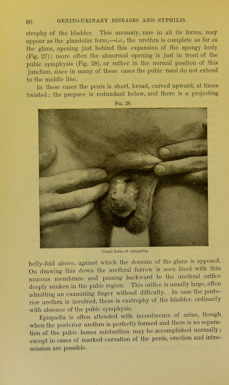 strophy of the bladder. This anomaly, rare in all its forms, may appear as the glandular form,—i.e., the urethra is complete as far as the glans, opening just behind this expansion of the spongy body (Fig. 27); more often the abnormal opening is just in front of the pubic symphysis (Fig. 28), or rather in the normal position of this junction, since in many of these cases the pubic rami do not extend to the middle hne. In these cases the penis is short, broad, curved upward, at times twisted; the prepuce is redundant below, and there is a projecting Fig. 28. 4 Usual I'urm of epispadia. belly-fold above, against which the dorsum of the glans is apposed. On drawing this down the urethral furrow is seen lined with thin mucous membrane and passing backward to the urethral orifice deeply sunken in the pubic region. This orifice is usually large, often admitting an examining finger without difficulty. In case the poste- rior urethra is involved, there is exstrophy of the bladder, ordmarily with absence of the pubic symphysis. Epispadia is often attended with incontinence of urme, though when the posterior urethra is perfectly formed and there is no separa- tion of the pubic bones micturition may be accomplished normally; except in cases of marked curvation of the penis, erection and intro- mission are possible.