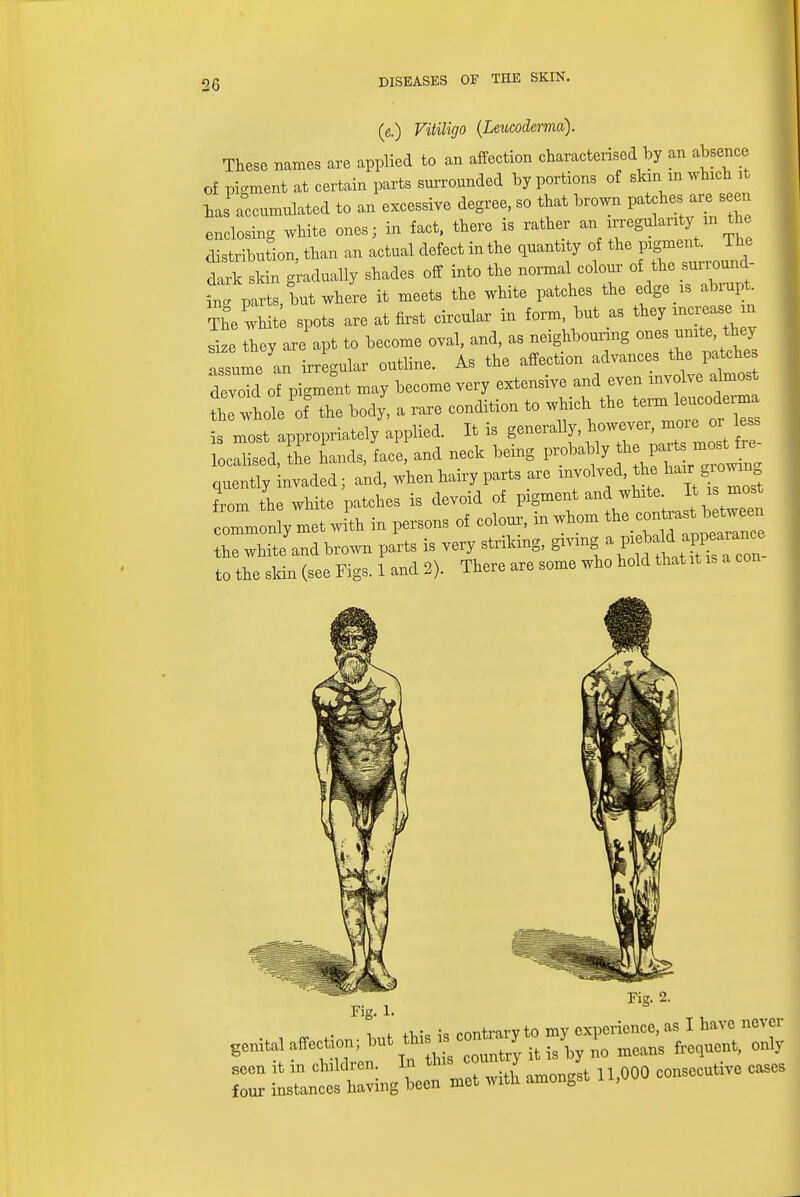 (e.) Vitiligo (Leucoderma). These names are applied to an affection characterised by an absence of pigment at certain parts surronnded by portions of skinm which it has accumulated to an excessive degree, so that brown patches are seen enclosing white ones; in fact, there is rather anRegularity^ the distribution, than an actual defect in the quantity of the pigment. The tl L gradually shades off into the normal colour of the pound- ing parts, but where it meets the white patches the edge » abrupt The whit spots are at first circular in form, but as they increase m size they areapt to become oval, and, as neighbouring ones urn t^ they assume an irregular outline. As the affection advances the patches devoTd of pigment may become very extensive and even involve almost the whole of the body, a rare condition to which the is most appropriately applied. It is generally however^a*e o^less localised, the hands, face, and neck being probably th quently invaded; and, when hairy parts are involved, the hair g^owm from the white patches is devoid of pigment and white. It is most oTm^ nttih in persons of colour, in whom the white and brown parts is very striking, giving a V^^ ^l to the skin (see Figs. 1 and 2). There are some who hold that it is a con Fig. 2. Fig. 1. z —*—n'oo° —ive CM0S