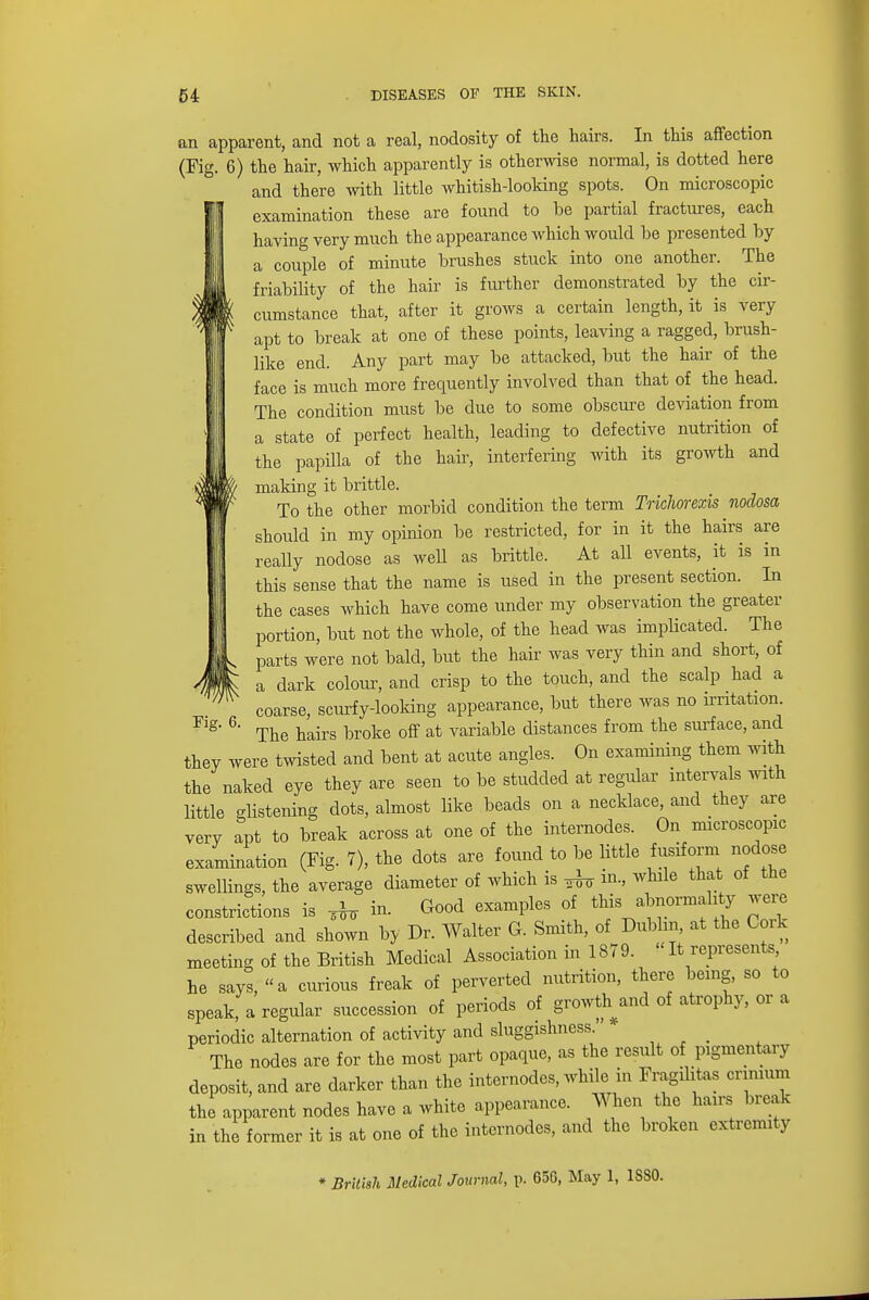 an apparent, and not a real, nodosity of the hairs. In this affection (Fig. 6) the hair, which apparently is otherwise normal, is dotted here and there with little whitish-looking spots. On microscopic examination these are found to be partial fractures, each having very much the appearance which would he presented by a couple of minute brushes stuck into one another. The friability of the hair is further demonstrated by the cir- cumstance that, after it grows a certain length, it is very apt to break at one of these points, leaving a ragged, brush- like end. Any part may be attacked, but the hair of the face is much more frequently involved than that of the head. The condition must be due to some obscure deviation from a state of perfect health, leading to defective nutrition of the papilla of the hair, interfering with its growth and making it brittle. To the other morbid condition the term Trichorexis nodosa should in my opinion be restricted, for in it the hairs are really nodose as well as brittle. At all events, it is in this sense that the name is used in the present section. In the cases which have come under my observation the greater portion, but not the whole, of the head was implicated. The parts were not bald, but the hair was very thin and short, of a dark colour, and crisp to the touch, and the scalp had a coarse, scurfy-looking appearance, but there was no irritation. The hairs broke off at variable distances from the surface, and they were twisted and bent at acute angles. On examining them with the naked eye they are seen to be studded at regular intervals with little glistening dots, almost like beads on a necklace, and they are very apt to break across at one of the internodes. On microscopic examination (Fig. 7), the dots are found to be little fusiform nodose swellings, the average diameter of which is ^ in., while that of the constrictions is ^ in. Good examples of this abnormality were described and shown by Dr. Walter G. Smith, of Dublin, at the Cork meeting of the British Medical Association in 1879. << It represents he says, a curious freak of perverted nutrition, there being, so to speak, a regular succession of periods of growth and of atrophy, or a periodic alternation of activity and sluggishness.' _ The nodes are for the most part opaque, as the result of pigmentary deposit, and are darker than the internodes, while in Fragihtas cnmum the apparent nodes have a white appearance. When the hairs break in the former it is at one of the internodes, and the broken extremity Fig. 6. * British Medical Journal, p. 65G, May 1, 1SS0.