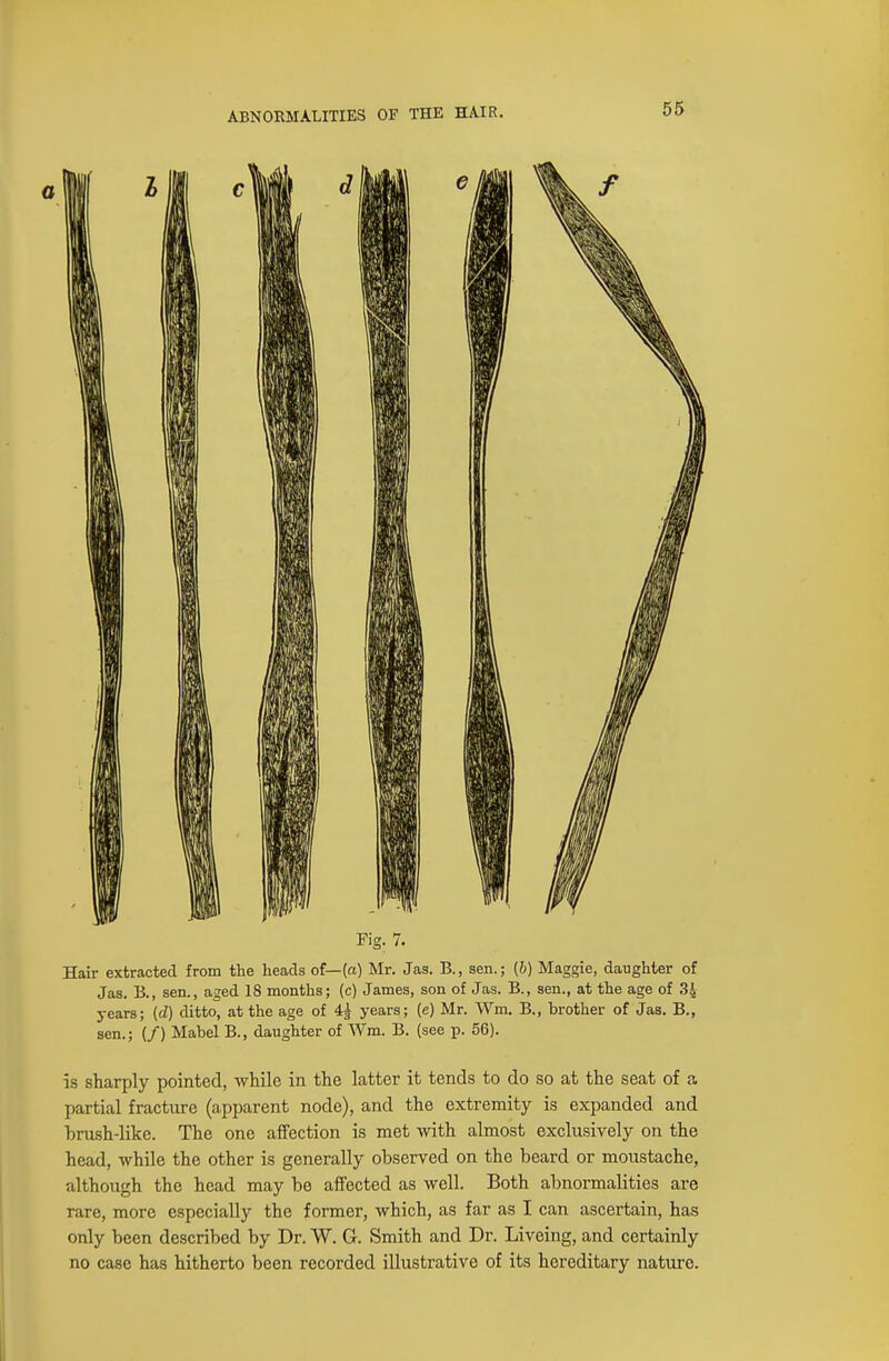 years; (d) ditto, at the age of 4£ years; (e) Mr. Wm. B., brother of Jas. B., sen.; (/) Mabel B., daughter of Wm. B. (see p. 56). is sharply pointed, while in the latter it tends to do so at the seat of a partial fracture (apparent node), and the extremity is expanded and brush-like. The one affection is met with almost exclusively on the head, while the other is generally observed on the beard or moustache, although the head may be affected as well. Both abnormalities are rare, more especially the former, which, as far as I can ascertain, has only been described by Dr. W. G. Smith and Dr. Liveing, and certainly no case has hitherto been recorded illustrative of its hereditary nature.