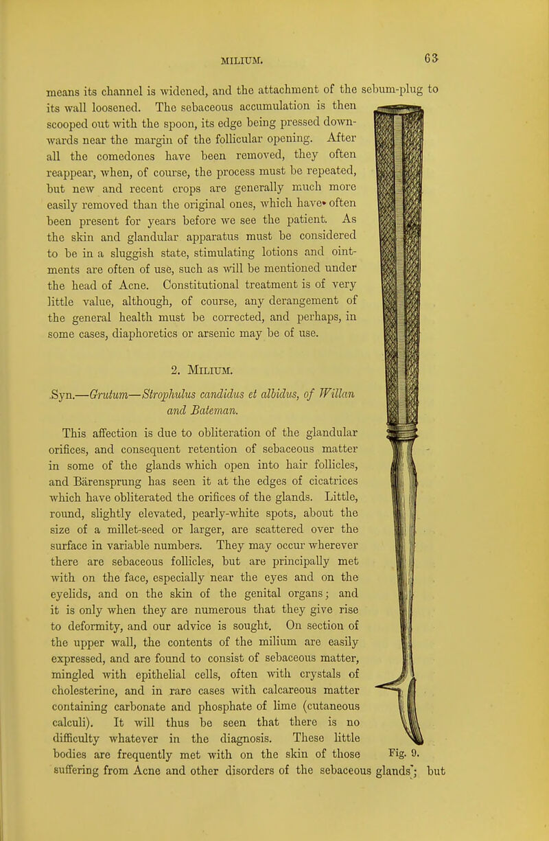 MILIUM. means its channel is widened, and the attachment of the sebum-plug to its wall loosened. The sebaceous accumulation is then scooped out with the spoon, its edge being pressed down- wards near the margin of the follicular opening. After all the comedones have been removed, they often reappear, when, of course, the process must be repeated, but new and recent crops are generally much more easily removed than the original ones, Avhich have* often been present for years before we see the patient. As the skin and glandular apparatus must be considered to be in a sluggish state, stimulating lotions and oint- ments are often of use, such as will be mentioned under the head of Acne. Constitutional treatment is of very little value, although, of course, any derangement of the general health must be corrected, and perhaps, in some cases, diaphoretics or arsenic may be of use. 2. Milium. .Syn.—Grutum—Strophulus Candidas et cdbidus, of Willan and Bateman. This affection is due to obliteration of the glandular orifices, and consequent retention of sebaceous matter in some of the glands which open into hair follicles, and Barensprung has seen it at the edges of cicatrices which have obliterated the orifices of the glands. Little, round, slightly elevated, pearly-white spots, about the size of a millet-seed or larger, are scattered over the surface in variable numbers. They may occur wherever there are sebaceous follicles, but are principally met with on the face, especially near the eyes and on the eyelids, and on the skin of the genital organs; and it is only when they are numerous that they give rise to deformity, and our advice is sought. On section of the upper wall, the contents of the milium are easily expressed, and are found to consist of sebaceous matter, mingled with epithelial cells, often with crystals of cholesterine, and in rare cases with calcareous matter containing carbonate and phosphate of lime (cutaneous calculi). It will thus be seen that there is no difficulty whatever in the diagnosis. These little bodies are frequently met with on the skin of those Fig. 9. suffering from Acne and other disorders of the sebaceous glands; but