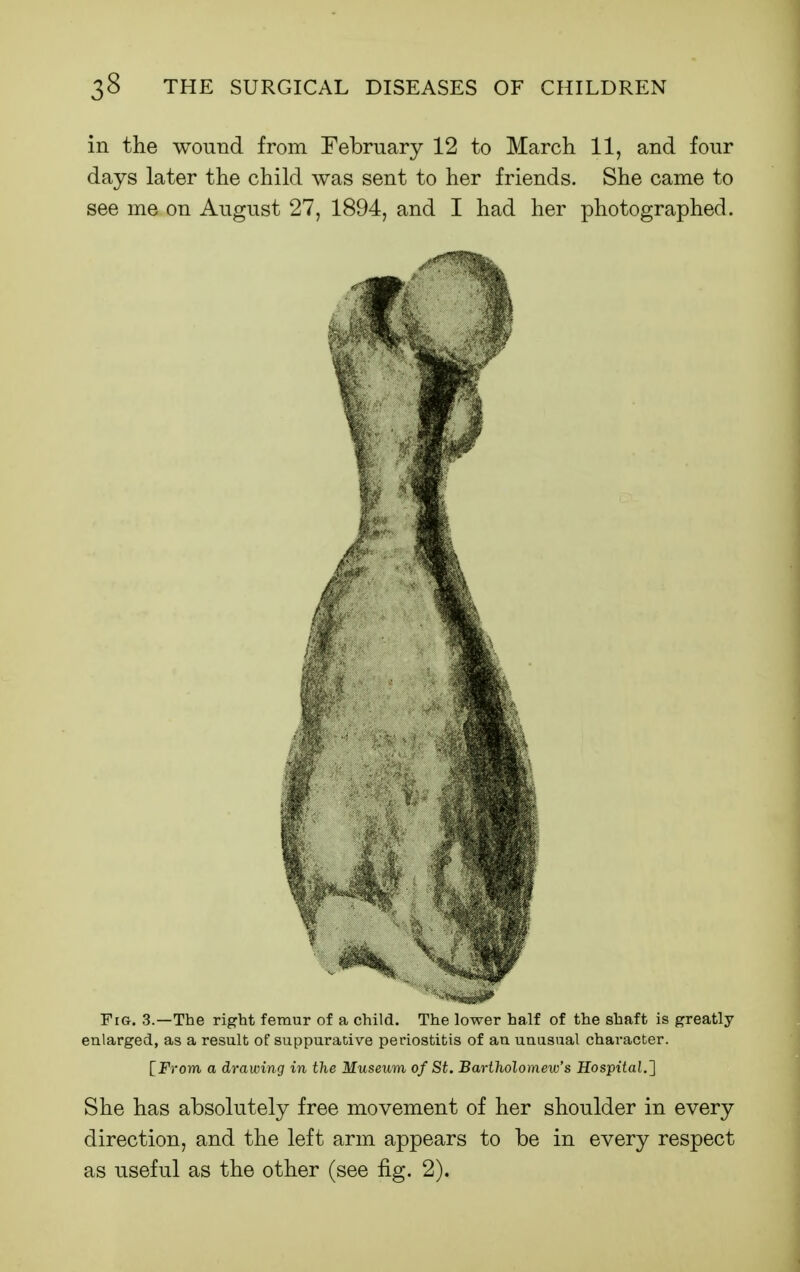 in the wound from February 12 to March 11, and four days later the child was sent to her friends. She came to see me on August 27, 1894, and I had her photographed. Fig. 3.—The right femur of a child. The lower half of the shaft is greatly enlarged, as a result of suppurative periostitis of au uausual character. [Prom a drawing in the Museum of St. Bartholomew's Hospital.^ She has absolutely free movement of her shoulder in every direction, and the left arm appears to be in every respect as useful as the other (see fig. 2).
