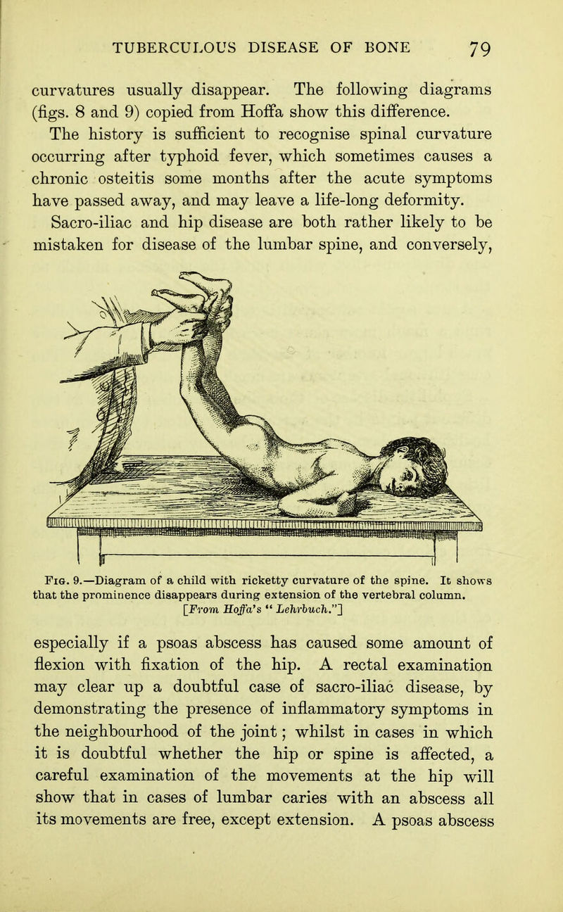 curvatures usually disappear. The following diagrams (figs. 8 and 9) copied from HofFa show this difference. The history is sufEcient to recognise spinal curvature occurring after typhoid fever, which sometimes causes a chronic osteitis some months after the acute symptoms have passed away, and may leave a life-long deformity. Sacro-iliac and hip disease are both rather likely to be mistaken for disease of the lumbar spine, and conversely. Fig. 9.—Diagram of a child with ricketty curvature of the spine. It shows that the prominence disappears during extension of the vertebral column, [from Soffa's  Lehrhucli.^ especially if a psoas abscess has caused some amount of flexion with fixation of the hip. A rectal examination may clear up a doubtful case of sacro-iliac disease, by demonstrating the presence of inflammatory symptoms in the neighbourhood of the joint; whilst in cases in which it is doubtful whether the hip or spine is affected, a careful examination of the movements at the hip will show that in cases of lumbar caries with an abscess all its movements are free, except extension. A psoas abscess