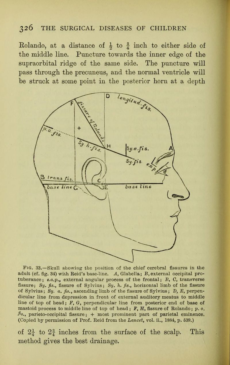 Rolando, at a distance of | to f inch to either side of the middle line. Puncture towards the inner edge of the supraorbital ridge of the same side. The puncture will pass through the precuneus, and the normal ventricle will be struck at some point in the posterior horn at a depth Fig. 33.—Skull showings the jjosition of the chief cerebral fissures in the adult (cf. fig. 34) with Reid's base-line. A, Glabella; B, external occipital pro- tuberance; e.a.p., external angular process of the frontal; B, C, transverse fissure; Sy. fis., fissure of Sylvius; Sy. h. fis., horizontal limb of the fissure of Sylvius; Sy. a. fis., ascending limb of the fissure of Sylvius; D, E, perpen- dicular line from depression in front of external auditory meatus to middle line of top of head; F, G, perpendicular line from posterior end of base of mastoid process to middle line of top of head ; F, H, fissure of Rolando; p. 0. fis., parieto-occipital fissure; + most prominent part of parietal eminence. (Copied by permission of Prof. Reid from the Lancet, vol. ii., 1884, p. 539.) of 2|- to 2| inches from the surface of the scalp. This method gives the best drainage.