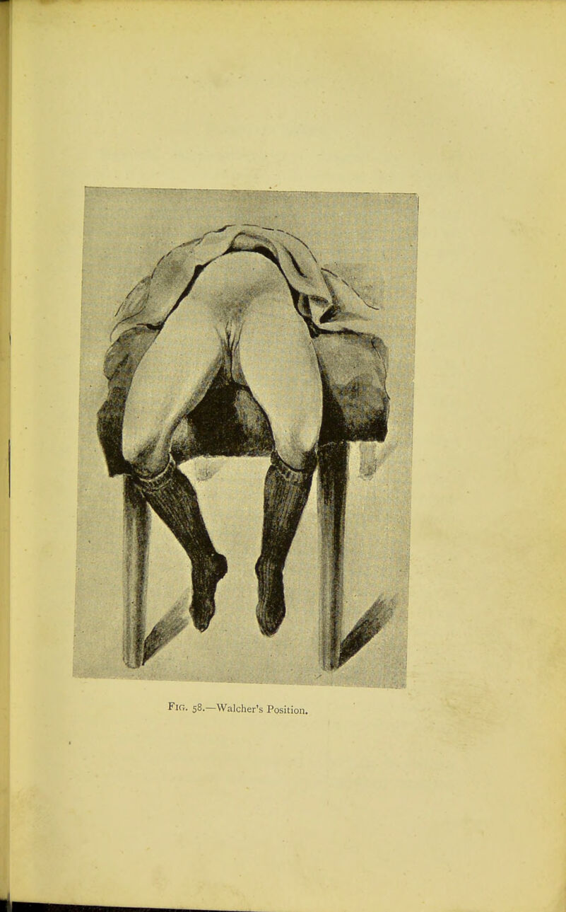 Fig. 58.—Walcher's Position.