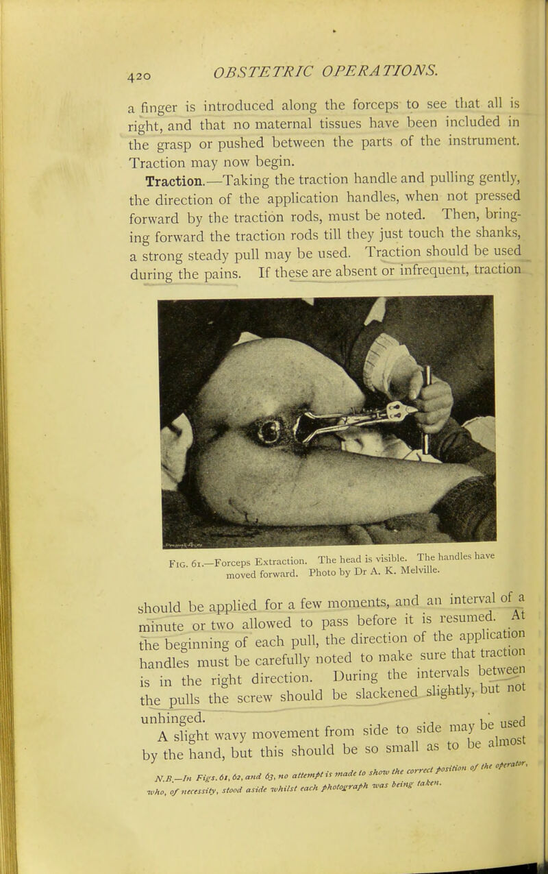 a finger is introduced along the forceps to see that all is right, and that no maternal tissues have been included in the grasp or pushed between the parts of the instrument. Traction may now begin. Traction.—Taking the traction handle and pulling gently, the direction of the application handles, when not pressed forward by the traction rods, must be noted. Then, bring- ing forward the traction rods till they just touch the shanks, a strong steady pull may be used. Traction should be used during the pains. If these are absent or infrequent, traction Fig 6x.-Forceps Extraction. The head is visible. The handles have moved forward. Photo by Dr A. K. Melville. should be applied for a few moments, and an interval of a minute or two allowed to pass before it is resumed. At the beginning of each pull, the direction of the apphca ion handles must be carefully noted to make sure that traction is in the right direction. During the intervals between the pulls the screw should be slackened slightly, but not unhinged. K ..~eA A slight wavy movement from side to side may be used by the hand, but this should be so small as to be almost jV B —In Figs. 61, 62, and 6j, no attempt is made to shcnu the correct position of the operator* who, 'of necessity, stood aside whilst each photograph was being taken.