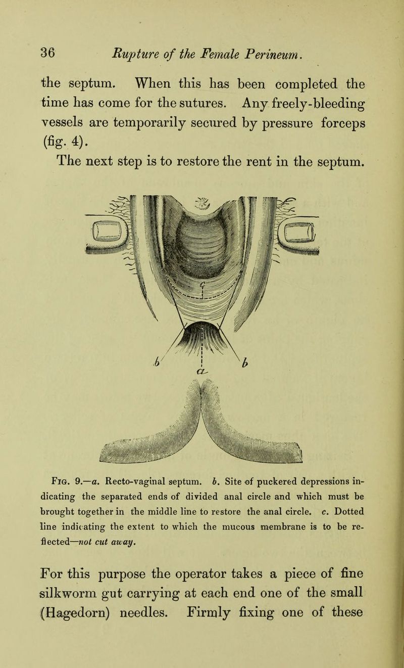 the septum. When this has been completed the time has come for the sutures. Any freely-bleeding vessels are temporarily secured by pressure forceps (fig. 4). The next step is to restore the rent in the septum. Fig. 9—a. Recto-vaginal septum, b. Site of puckered depressions in- dicating the separated ends of divided anal circle and which must be brought together in the middle line to restore the anal circle, c. Dotted line indicating the extent to which the mucous membrane is to be re- flected—not cut away. For this purpose the operator takes a piece of fine silkworm gut carrying at each end one of the small (Hagedorn) needles. Firmly fixing one of these