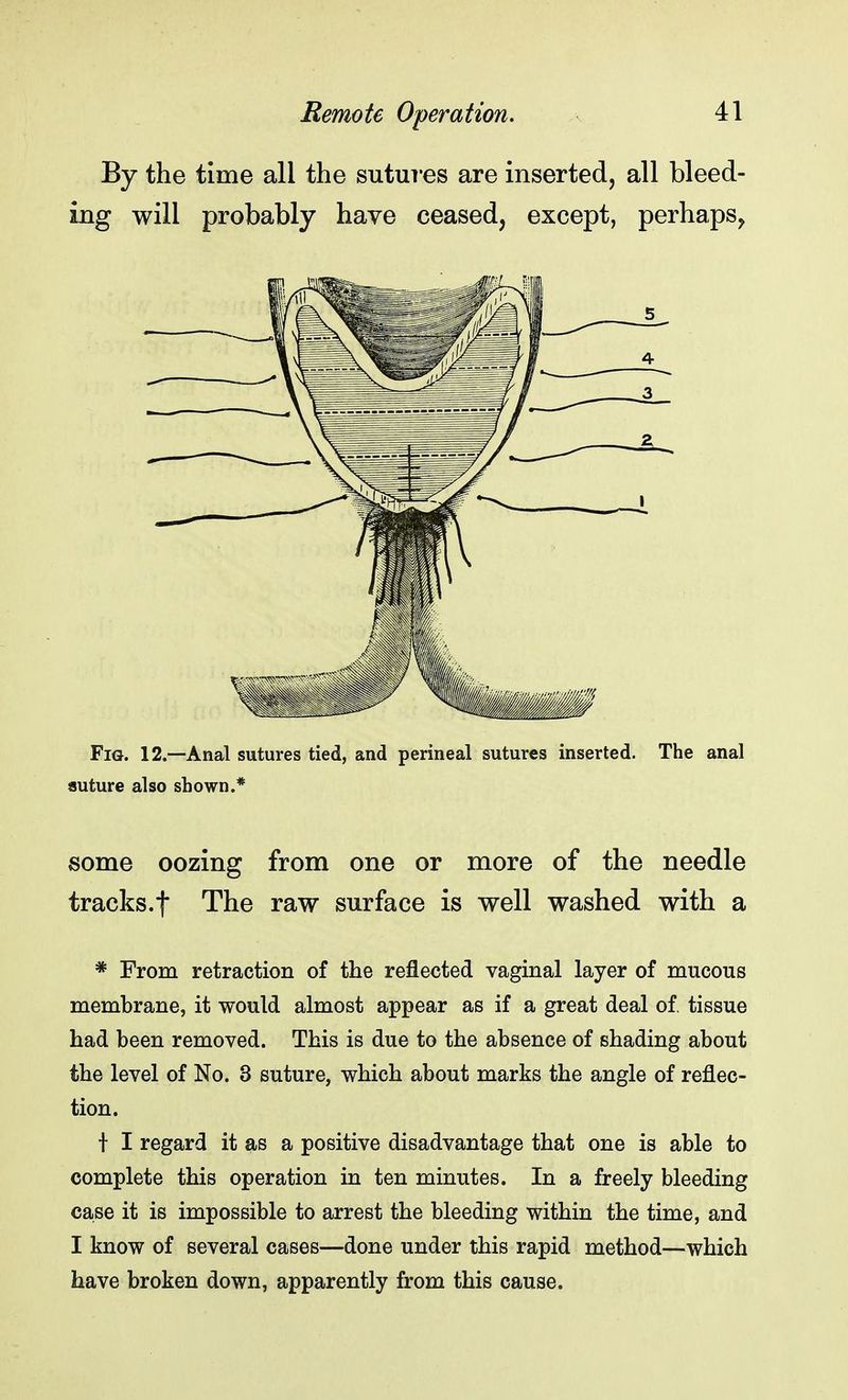By the time all the sutures are inserted, all bleed- ing will probably have ceased, except, perhaps, Fig. 12.—Anal sutures tied, and perineal sutures inserted. The anal suture also shown.* some oozing from one or more of the needle tracks.f The raw surface is well washed with a * From retraction of the reflected vaginal layer of mucous membrane, it would almost appear as if a great deal of. tissue had been removed. This is due to the absence of shading about the level of No. 3 suture, which about marks the angle of reflec- tion. I I regard it as a positive disadvantage that one is able to complete this operation in ten minutes. In a freely bleeding case it is impossible to arrest the bleeding within the time, and I know of several cases—done under this rapid method—which have broken down, apparently from this cause.