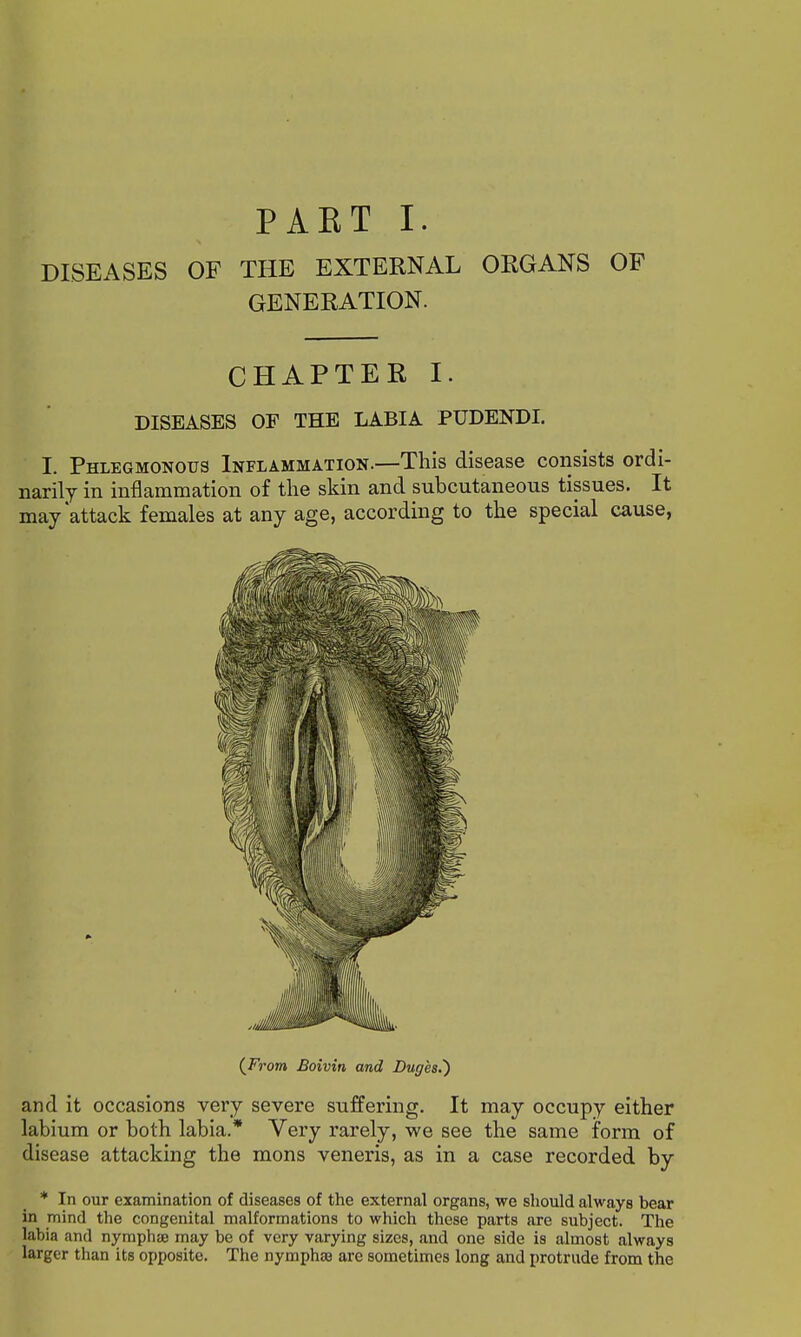 PAKT I. DISEASES OF THE EXTERNAL ORGANS OF GENERATION. CHAPTER I. DISEASES OF THE LABIA PUDENDI. I. Phlegmonous Inflammation.—This disease consists ordi- narily in inflammation of the skin and subcutaneous tissues. It may attack females at any age, according to the special cause, {From Boivin and Duges.) and it occasions very severe suffering. It may occupy either labium or both labia.* Very rarely, we see the same form of disease attacking the mons veneris, as in a case recorded by * In our examination of diseases of the external organs, we should always bear in mind the congenital malformations to which these parts are subject. The labia and nymphte may be of very varying sizes, and one side is almost always larger than its opposite. The nymphiB are sometimes long and protrude from the