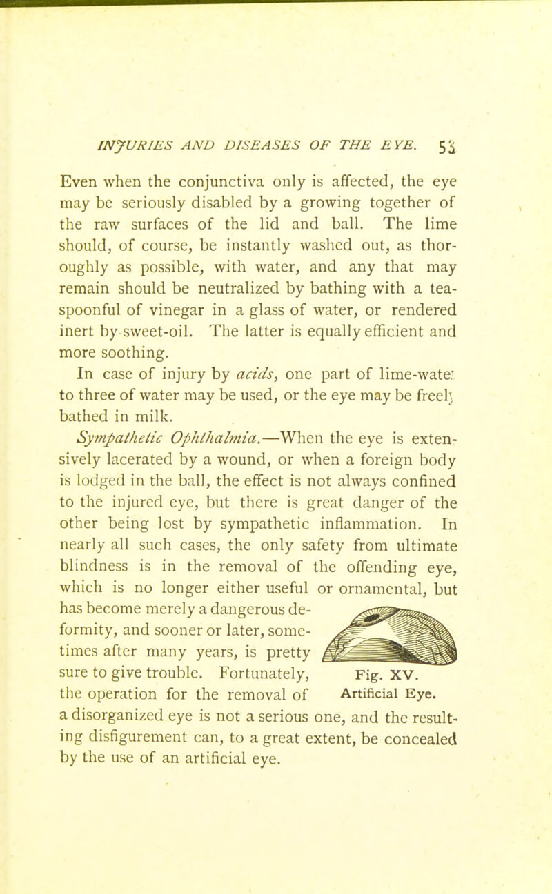 Even when the conjunctiva only is affected, the eye may be seriously disabled by a growing together of the raw surfaces of the lid and ball. The lime should, of course, be instantly washed out, as thor- oughly as possible, with water, and any that may remain should be neutralized by bathing with a tea- spoonful of vinegar in a glass of water, or rendered inert by sweet-oil. The latter is equally efficient and more soothing. In case of injury by adds, one part of lime-wate- to three of water may be used, or the eye may be freel} bathed in milk. Sympathetic Ophihalmia.—When the eye is exten- sively lacerated by a wound, or when a foreign body is lodged in the ball, the effect is not always confined to the injured eye, but there is great danger of the other being lost by sympathetic inflammation. In nearly all such cases, the only safety from ultimate blindness is in the removal of the offending eye, which is no longer either useful or ornamental, but has become merely a dangerous de- formity, and sooner or later, some- times after many years, is pretty sure to give trouble. Fortunately, Fig. XV. the operation for the removal of Artificial Eye. a disorganized eye is not a serious one, and the result- ing disfigurement can, to a great extent, be concealed by the use of an artificial eye.