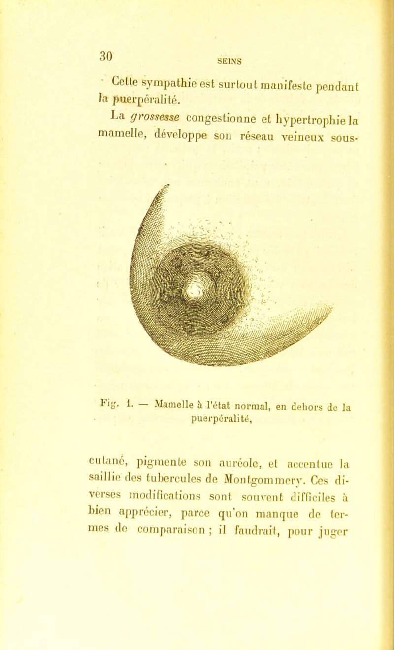 Celte sympathie est surtout manifeste pendant la puerpéralité. La grossesse congestionne et hypertrophie la mamelle, développe son réseau veineux sous- Fig. 1. — Mamelle à l'état normal, en dehors de la puerpéralité, cutané, pigmente son auréole, et accentue la saillie des tubercules de Monlgommery. Ces di- verses modifications sont souvent difficiles à bien apprécier, parce qu'on manque de ter- mes de comparaison; il faudrait, pour juger