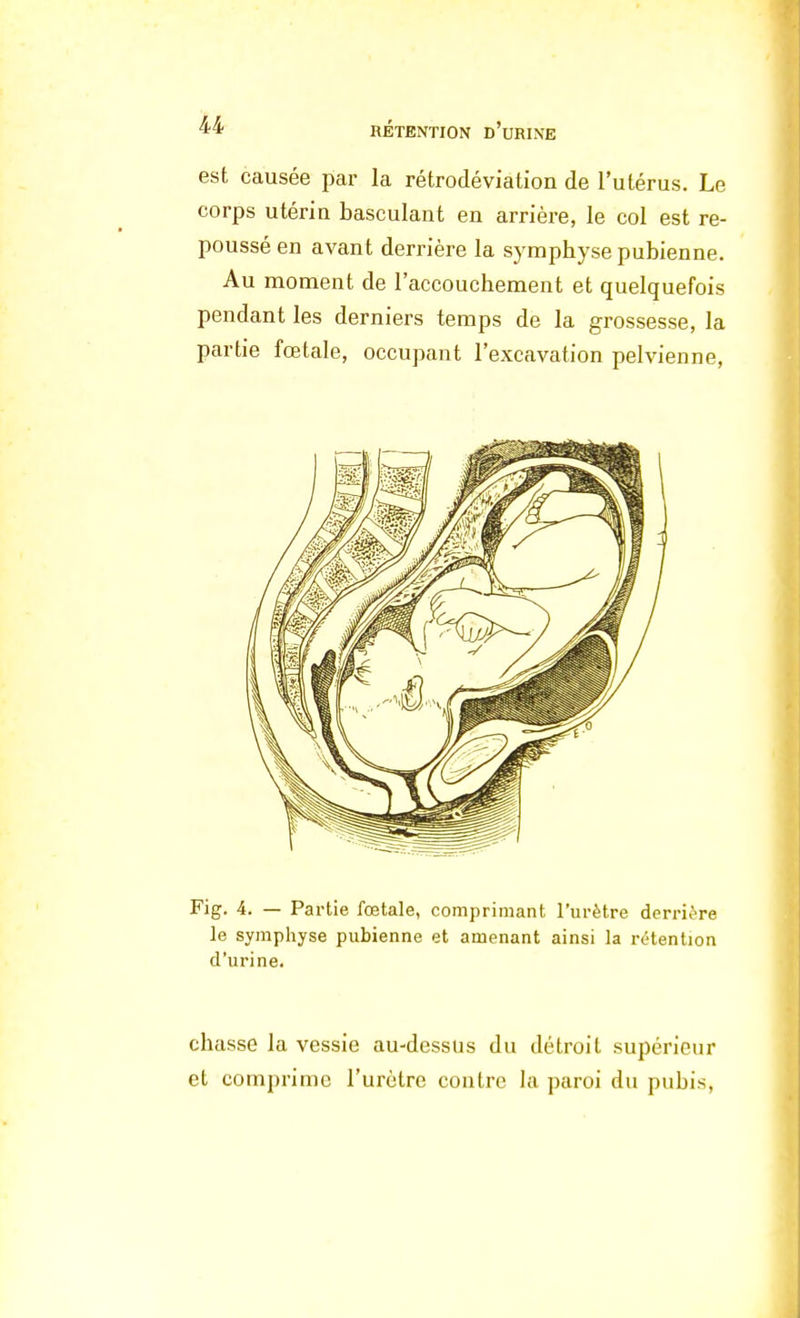 est causée par la rétrodéviation de l'utérus. Le corps utérin basculant en arrière, le col est re- poussé en avant derrière la symphyse pubienne. Au moment de l'accouchement et quelquefois pendant les derniers temps de la grossesse, la partie fœtale, occupant l'excavation pelvienne, Fig. 4. — Partie fœtale, comprimant l'urètre derrière le symphyse pubienne et amenant ainsi la rétention d'urine. chasse la vessie au-dessus du détroit supérieur et comprime l'urètre contre la paroi du pubis,