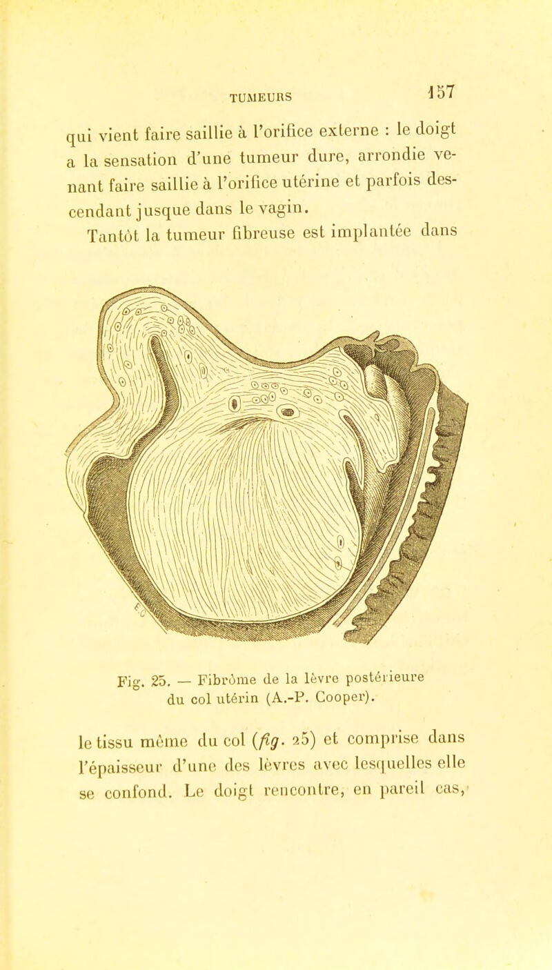 qui vient faire saillie à l'orifice externe : le doigt a la sensation d'une tumeur dure, arrondie ve- nant faire saillie à l'orifice utérine et parfois des- cendant jusque dans le vagin. Tantôt la tumeur fibreuse est implantée dans Fig. 25. — Fibrome de la lèvre postérieure du col utérin (A.-P. Cooper). le tissu même du col {fig. 25) et comprise dans l'épaisseur d'une des lèvres avec lesquelles elle se confond. Le doigt rencontre, en pareil cas,'