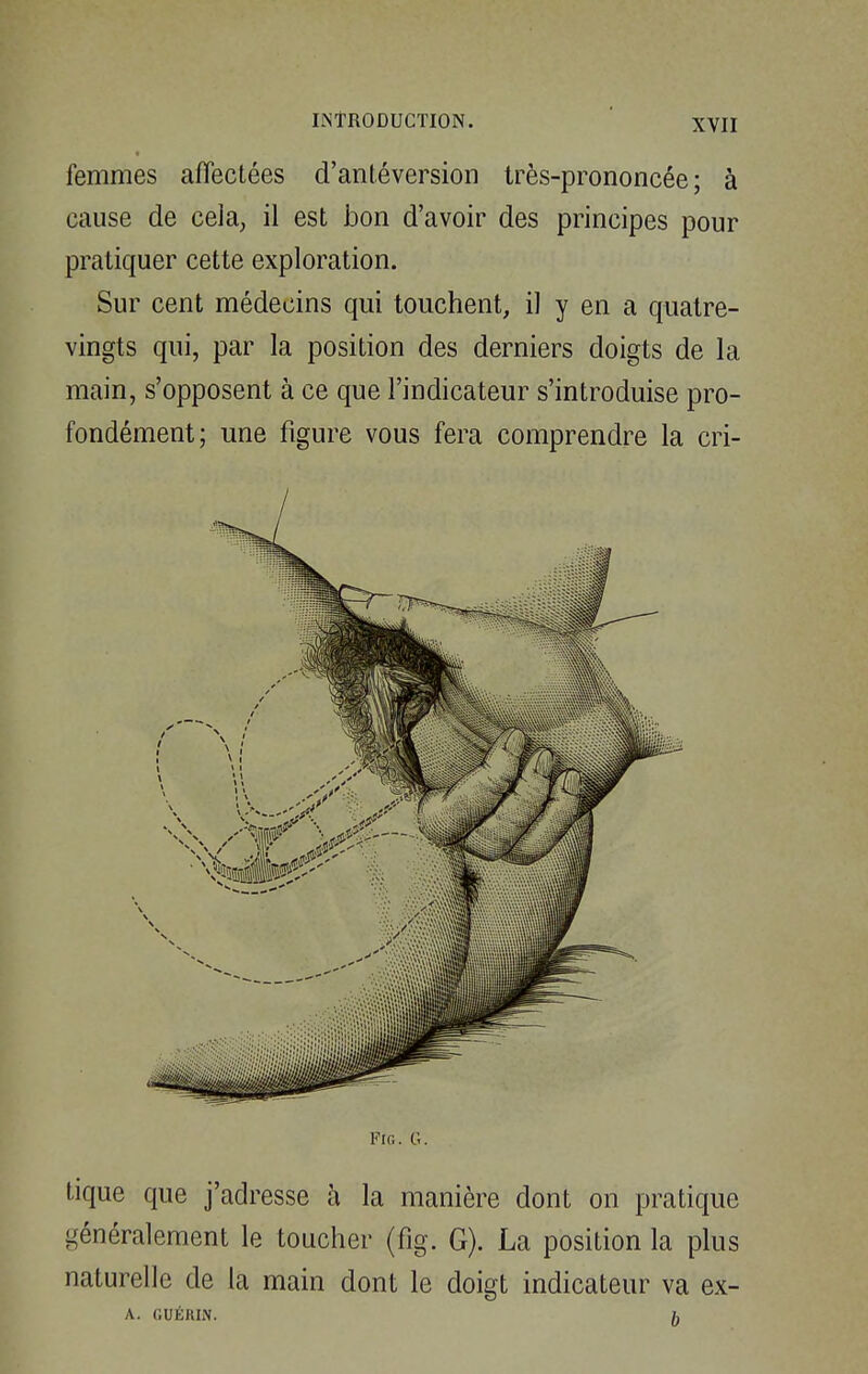 femmes affectées d'antéversion très-prononcée; à cause de cela, il est bon d'avoir des principes pour pratiquer cette exploration. Sur cent médecins qui touchent, il y en a quatre- vingts qui, par la position des derniers doigts de la main, s'opposent à ce que l'indicateur s'introduise pro- fondément; une figure vous fera comprendre la cri- Fic. G. tique que j'adresse à la manière dont on pratique généralement le toucher (fig. G). La position la plus naturelle de la main dont le doigt indicateur va ex- A. GUÉR1N. 5