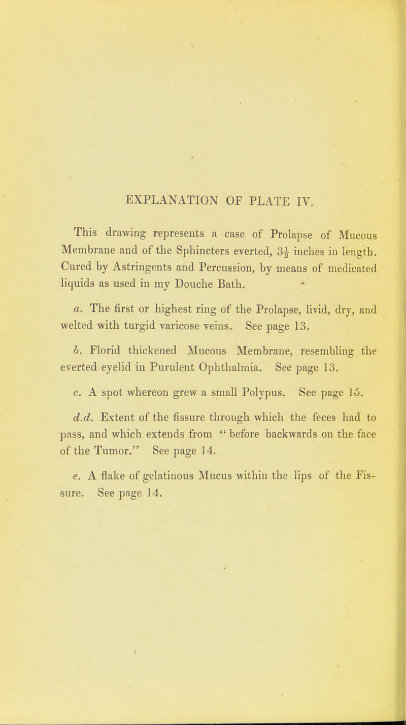 This drawing represents a case of Prolapse of Mucous Membrane and of the Sphincters everted, 3| inches in length. Cured by Astringents and Percussion, by means of medicated liquids as used in my Douche Bath. a. The first or highest ring of the Prolapse, livid, dry, and welted with turgid varicose veins. See page 13. b. Florid thickened Mucous Membrane, resembling the everted eyelid in Purulent Ophthalmia. See page 13. c. A spot whereon grew a small Polypus. See page 15. d. d. Extent of the fissure through which the feces had to pass, and which extends from  before backwards on the face of the Tumor. See page 14. e. A flake of gelatinous Mucus within the lips of the Fis- sure. See page 14.