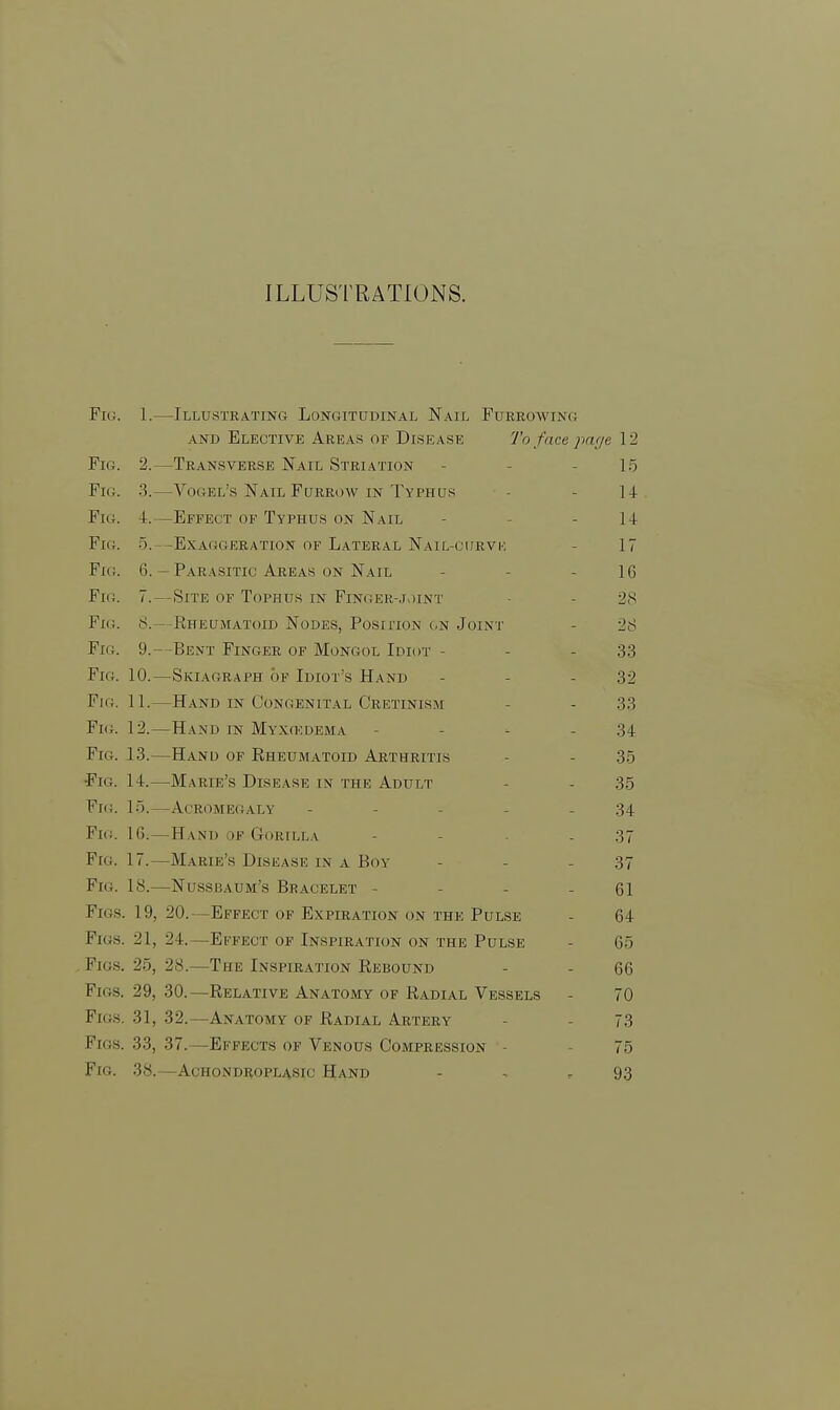 ILLUSTRATIONS. Fiu. 1.—Illustrating Longitudinal Nail Furrowinc and Elective Areas of Disease To face page 12 Fig. 2.—Transverse Nail Striation - -15 Fig. 3.—Vogel's Nail Furrow in Typhus 14 Fig. 4. -Effect of Typhus on Nail 14 Fig. 5.—Exaggeration of Lateral Nail-curve 17 Fig. 6.—Parasitic Areas on Nail 16 Fig. 7. — Site of Tophus in Finger-joint • - 28 Fig. S.—Rheumatoid Nodes, Position on Joint - 28 Fig. 9.—Bent Finger of Mongol Idiot - - - 33 Fig. 10.—Skiagraph of Idiot's Hand - 32 Fig. 11.—Hand in Congenital Cretinism - - 33 Fig. 12.—Hand in Myxedema - - - - 34 Fig. 13.—Hand of Rheumatoid Arthritis - - 35 Fig. 14.—Marie's Disease in the Adult - - 35 Fig. 15.—Acromegaly ----- 34 Fk;. 16.—Hand of Gorilla - - - - 37 Fig. 17.—Marie's Disease in a Boy - - - 37 Fig. 18.—Nussbaum's Bracelet - - - - 61 Figs. 19, 20.—Effect of Expiration on the Pulse - 64 Figs. 21, 24.—Effect of Inspiration on the Pulse - 65 Figs. 25, 28.—The Inspiration Rebound - - 66 Figs. 29, 30.—Relative Anatomy of Radial Vessels - 70 Figs. 31, 32.—Anatomy of Radial Artery - - 73 Figs. 33, 37. Effects of Venous Compression - 75 Fig. 38.—Achondroplasic Hand - , 93
