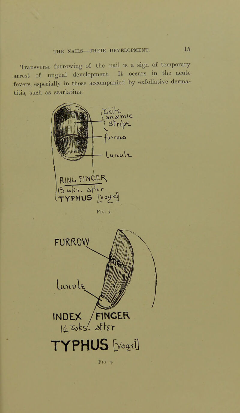 Transverse furrowing of the nail is a sign of temporary arrest of ungual development. It occurs in the acute fevers, especially in those accompanied by exfoliative derma- titis, such as scarlatina. V anemic TYPHUS [VQ2^ Fig. 3. FURROW IjLOLul INDEX /FINGER TYPHUS fropH