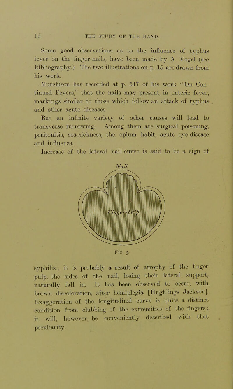 Some good observations as to the influence of typhus fever on the finger-nails, have been made by A. Vogel (see Bibliography.) The two illustrations on p. 15 are drawn from his work. Murchison has recorded at p. 517 of. his work On Con- tinued Fevers, that the nails may present, in enteric fever, markings similar to those which follow an attack of typhus and other acute diseases. But an infinite variety of other causes will lead to transverse furrowing. Among them are surgical poisoning, peritonitis, sea-sickness, the opium habit, acute eye-disease and influenza. Increase of the lateral nail-curve is said to be a sign of Nail pulp, the sides of the nail, losing their lateral support, naturally fall in. It has been observed to occur, with brown discoloration, after hemiplegia [Hughlings Jackson]. Exaggeration of the longitudinal curve is quite a distinct condition from clubbing of the extremities of the fingers; it will, however, be conveniently described with that peculiarity.