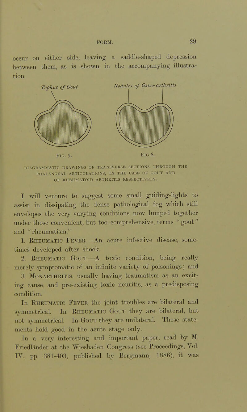 occur on either side, leaving a saddle-shaped depression between them, as is shown in the accompanying illustra- tion. Fig. 7. Fig 8. DIAGRAMMATIC DRAWINGS OK TRANSVERSE SECTIONS THROUGH THE PHALANGEAL ARTICULATIONS, IN THE CASE OF GOUT AND OF RHEUMATOID ARTHRITIS RESPECTIVELY. I will venture to suggest some small guiding-lights to assist in dissipating the dense pathological fog which still envelopes the very varying conditions now lumped together under those convenient, but too comprehensive, terms gout and rheumatism. 1. Eheumatic Fever.—An acute infective disease, some- times developed after shock. 2. Rheumatic Gout.—A toxic condition, being really merely symptomatic of an infinite variety of poisonings; and 3. Monarthritis, usually having traumatism as an excit- ing cause, and pre-existing toxic neuritis, as a predisposing condition. In Rheumatic Fever the joint troubles are bilateral and symmetrical. In Rheumatic Gout they are bilateral, but not symmetrical. In Gout they are unilateral. These state- ments hold good in the acute stage only. In a very interesting and important paper, read by M. Friedlander at the Wiesbaden Congress (see Proceedings, Vol. IV., pp. 381-403, published by Bergmann, 1886), it was