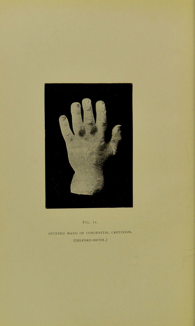 Fig. ii. stunted hand ok congenital cretinism. (telford-smith.)