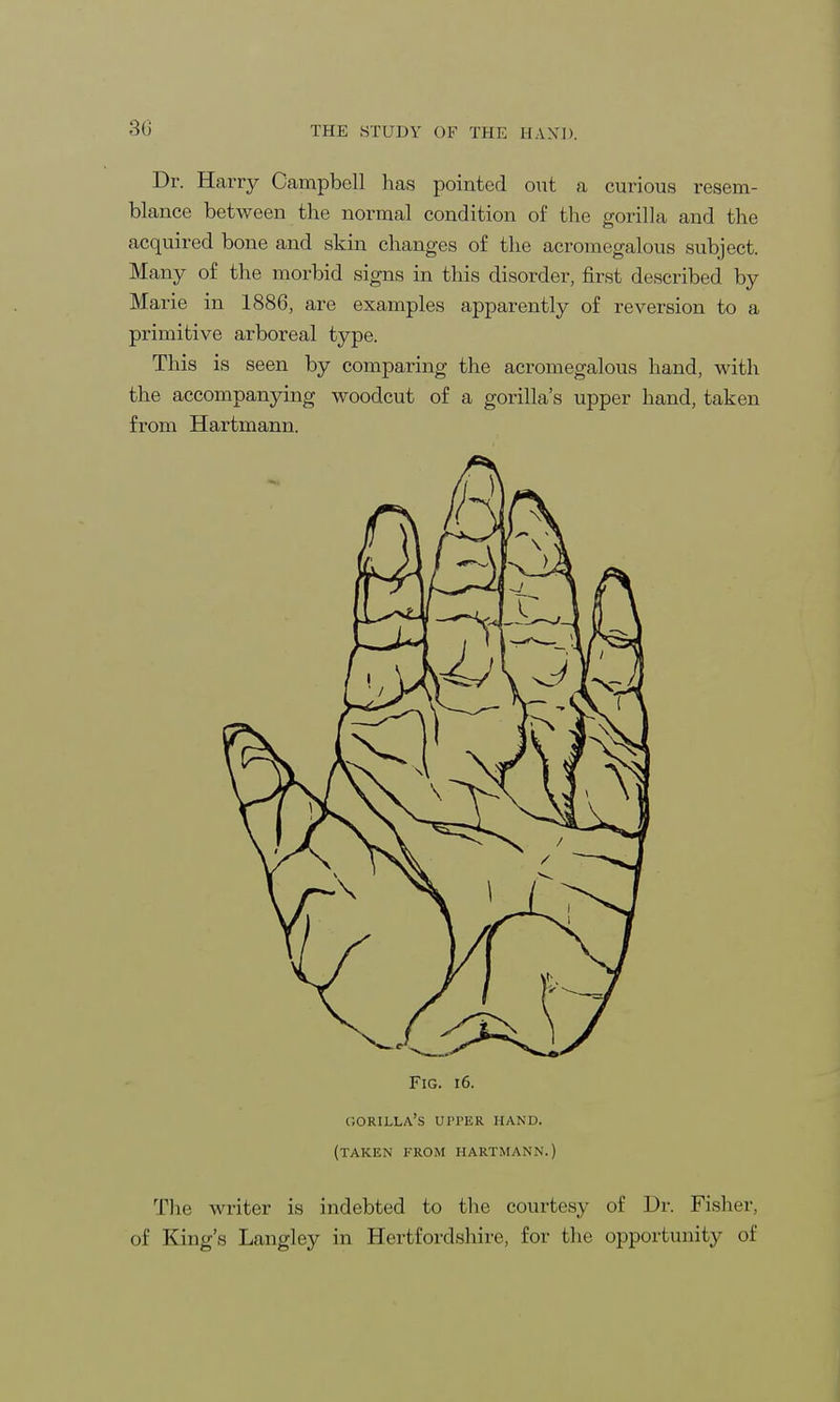 30 Dr. Harry Campbell has pointed out a curious resem- blance between the normal condition of the gorilla and the acquired bone and skin changes of the acromegalous subject. Many of the morbid signs in this disorder, first described by Marie in 1886, are examples apparently of reversion to a primitive arboreal type. This is seen by comparing the acromegalous hand, with the accompanying woodcut of a gorilla's upper hand, taken from Hartmann. Fig. 16. gorilla's upper hand, (taken from hartmann.) The writer is indebted to the courtesy of Dr. Fisher, of King's Langley in Hertfordshire, for the opportunity of