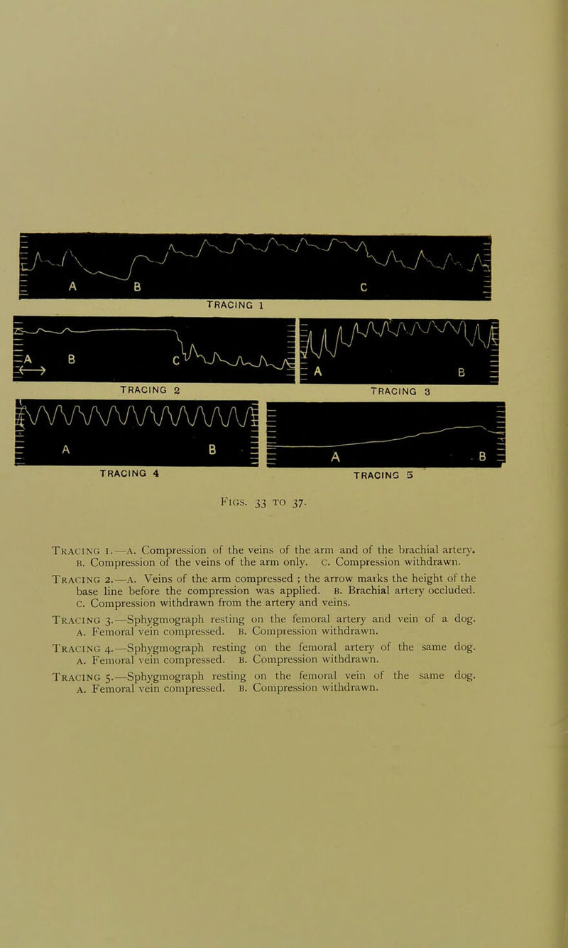 TRACING 2 TRACING 3 TRACING 4 TRACING 5 Figs. 33 to 37. Tracing i.—a. Compression of the veins of the arm and of the brachial artery. B. Compression of the veins of the arm only. c. Compression withdrawn. Tracing 2.—a. Veins of the arm compressed ; the arrow marks the height of the base line before the compression was applied. B. Brachial artery occluded, c. Compression withdrawn from the artery and veins. Tracing 3.—Sphygmograph resting on the femoral artery and vein of a dog. a. Femoral vein compressed. B. Compression withdrawn. Tracing 4.—Sphygmograph resting on the femoral artery of the same dog. a. Femoral vein compressed. B. Compression withdrawn. Tracing 5.—Sphygmograph resting on the femoral vein of the same dog. a. Femoral vein compressed. B. Compression withdrawn.