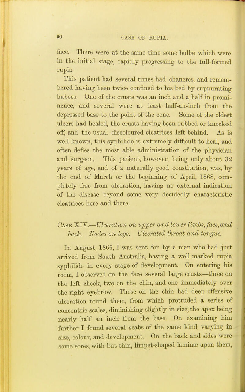 CASE OF RUPIA, face. There were at the same time some bullae which were in the initial stage, rapidly progressing to the full-formed rupia. This patient had several times had chancres, and remem- bered having been twice confined to his bed by suppurating buboes. One of the crusts was an inch and a half in promi- nence, and several were at least half-an-inch from the depressed base to the point of the cone. Some of the oldest ulcers had healed, the crusts having been rubbed or knocked off, and the usual discoloured cicatrices left behind. As is well known, this syphilide is extremely difficult to heal, and often defies the most able administration of the physician and surgeon. This patient, however, being only about 32 years of age, and of a naturally good constitution, was, by the end of March or the beginning of April, 1868, com- pletely free from ulceration, having no external indication of the disease beyond some very decidedly characteristic cicatrices here and there. Case XIV.— Ulceration on upper and lower limbs, face, and back. Nodes on legs. Ulcerated throat and tongue. In August, 1866, I was sent for by a man who had just arrived from South Australia, having a well-marked rupia syphilide in every stage of development. On entering his room, I observed on the face several large crusts—three on the left cheek, two on the chin, and one immediately over the right eyebrow. Those on the chin had deep offensive ulceration round them, from which protruded a series of concentric scales, diminishing slightly in size, the apex being nearly half an inch from the base. On examining him further I found several scabs of the same kind, varying in size, colour, and development. On the back and sides were some sores, with but thin, limpet-shaped laminae upon them,