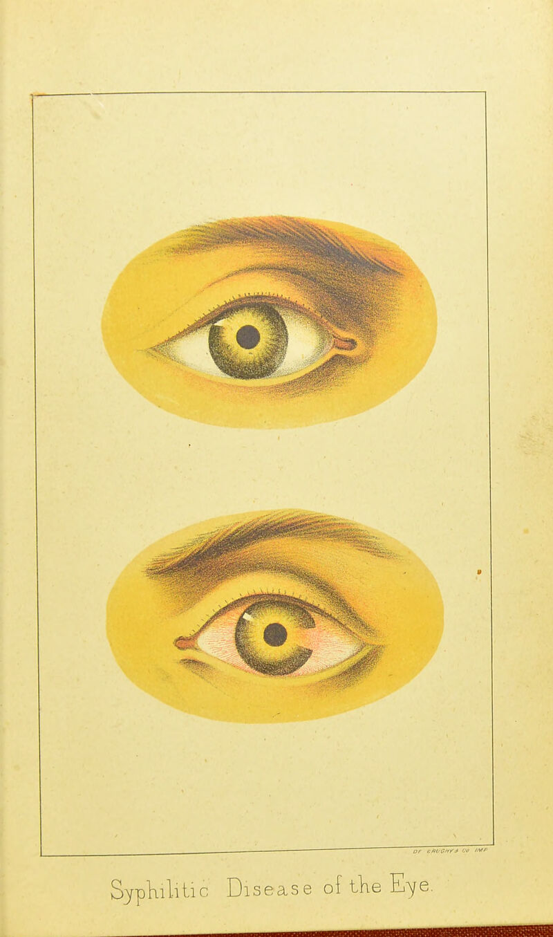 or c/roc^fJ '-f SypKilitic Disease of tKe Eye