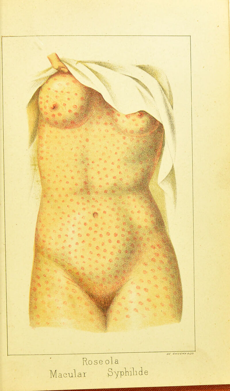 Roseola Macular gypHide