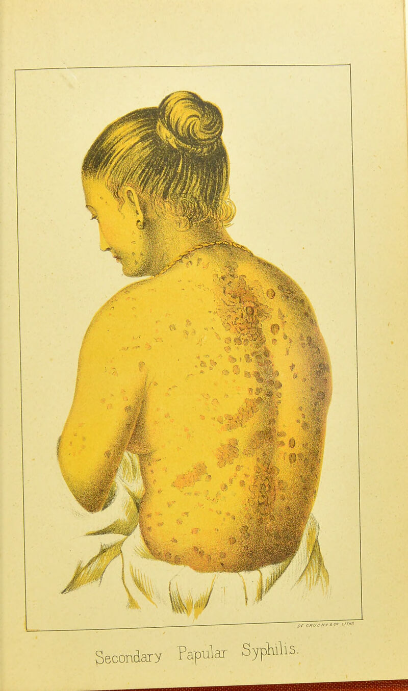 01 cRuctty'c' I'W Secondary Papular SypMl