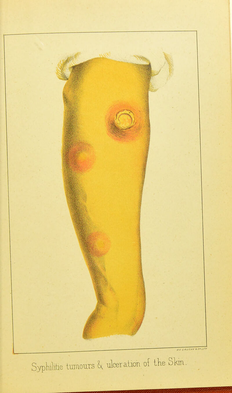 SypMitic tmouTS \ ulcer atioTi of iKe Sl^.
