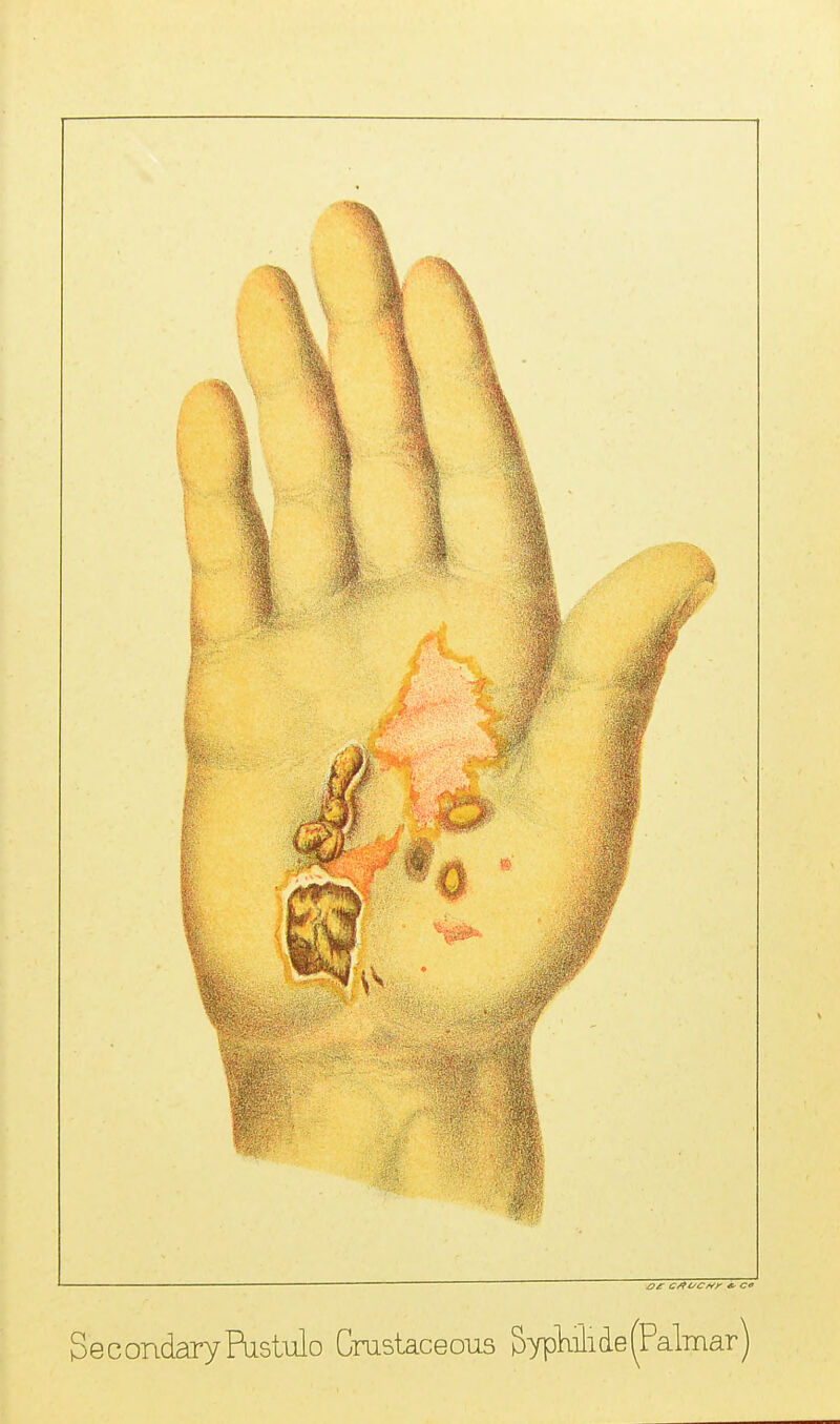 — — ' ~~ ~ z?/r c/fi/c^y *■ c« SecondaryPiistuilo Cmstaceous Sypliilide(Palmar)