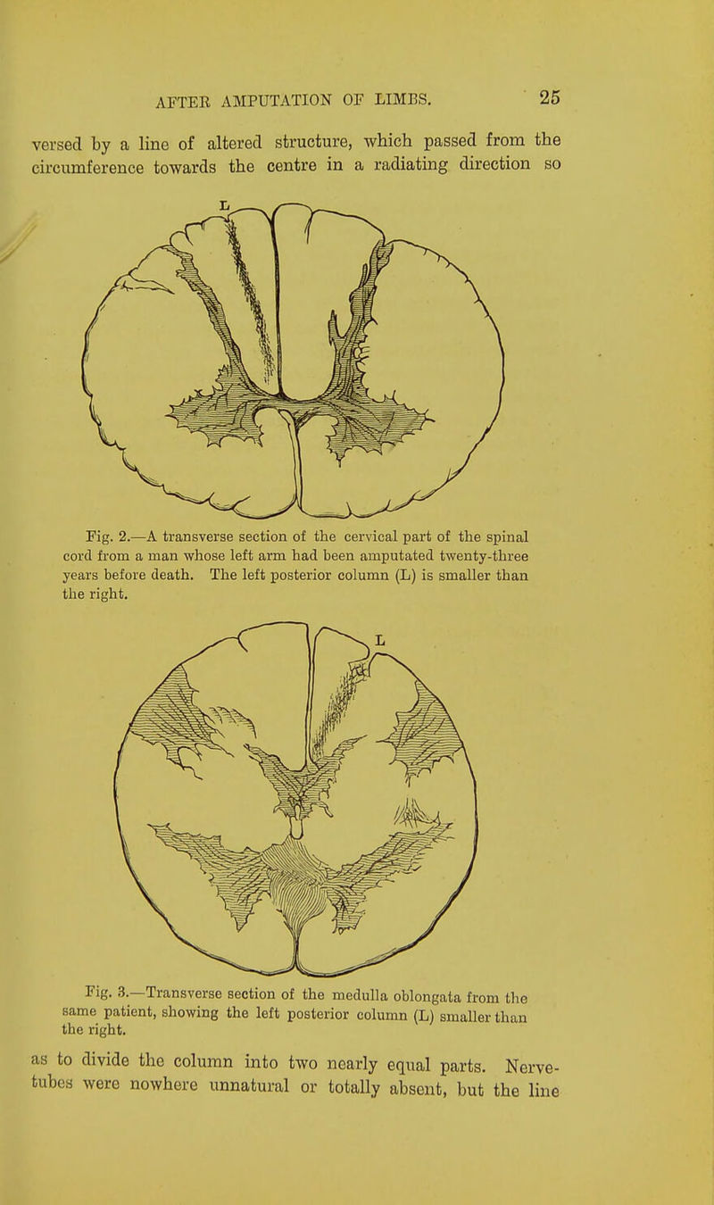 versed by a line of altered structure, which passed from the circumference towards the centre in a radiating direction so Fig. 2.—A transverse section of the cervical part of the spinal cord from a man whose left arm had been amputated twenty-three years before death. The left posterior column (L) is smaller than the right. Fig. 3.—Transverse section of the medulla oblongata from the same patient, showing the left posterior column (L) smaller than the right. as to divide the column into two nearly equal parts. Nerve- tubes were nowhere unnatural or totally absent, but the line