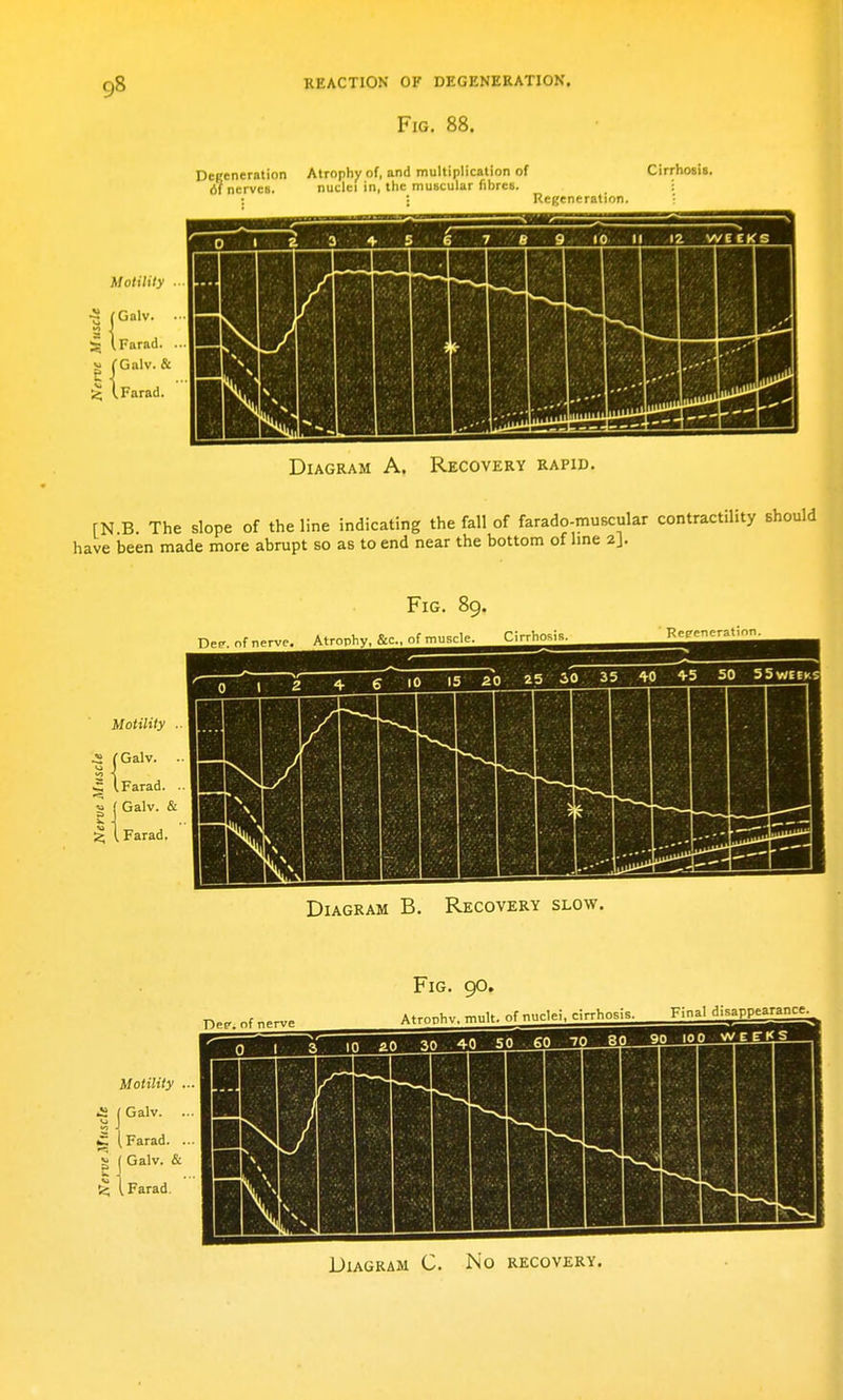 Fig. 88. Degeneration Atrophy of, and multiplication of 61 nerves. nuclei in, the muscular fibres. Cirrhosis. Motility . 5 l^'' [Farad. . j; fGalv. & Farad. Diagram A. Recovery rapid. [N B. The slope of the line indicating the fall of farado-muscular contractility should have been made more abrupt so as to end near the bottom of hne 2]. Fig. 89. Dep. nf nerve. Atrophy, &c., of muscle. CirrhoMs Kepeneratinn. Motility .. .2 fOalv. . 5 1 Farad. ■■ g j Galv. & •Z, I Farad, Diagram B. Recovery slow. Fig. 90. Diagram C. No recovery.