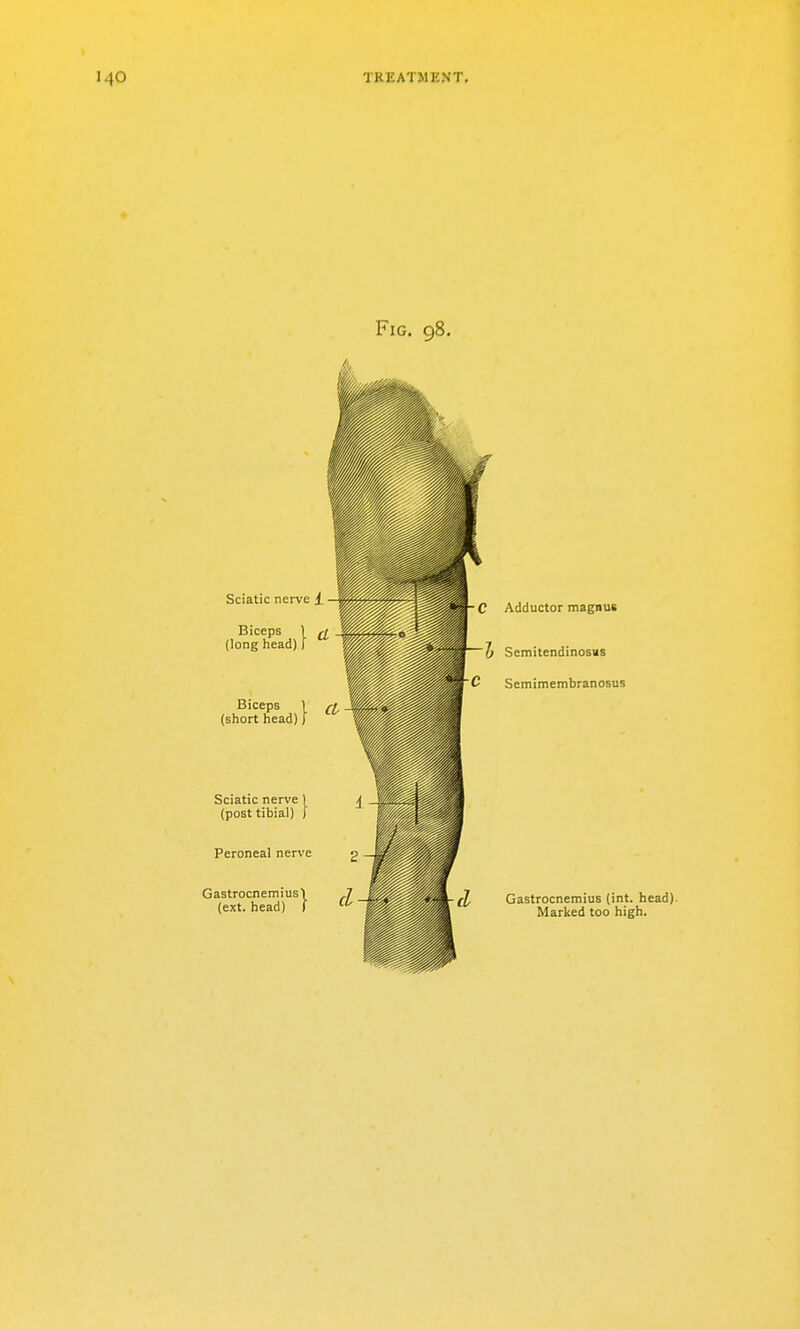 Fig. 98. Sciatic nerve i_ - Biceps 1 ^ (long head) ) Biceps 1 (short head) J :c nerve ) :tibial) f Sciatic nerve) (post 1 Peroneal nerve Gastrocnemius\ (ext. head) I C Adductor magnus J} Semitendinosus C Semimembranosus Gastrocnemius (int. head). Marked too high.