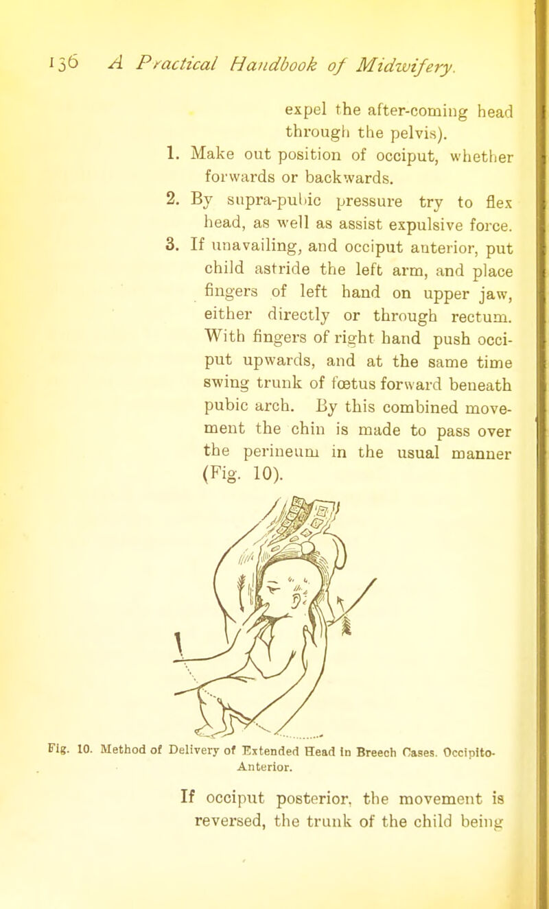 expel the after-coming head through the pelvis). 1. Make out position of occiput, whether forwards or backwards. 2. By supra-puhic pressure try to flex head, as well as assist expulsive force. 3. If unavailing, and occiput anterior, put child astride the left arm, and place fingers of left hand on upper jaw, either directly or through rectum. With fingers of right hand push occi- put upwards, and at the same time swing trunk of foetus forward beneath pubic arch. By this combined move- ment the chin is made to pass over the perineum in the usual manner (Fig. 10). Fig. 10. Method of Delivery of Extended Head \a Breech Cases. Occipito- Anterior. If occiput posterior, the movement is reversed, the trunk of the child beint: