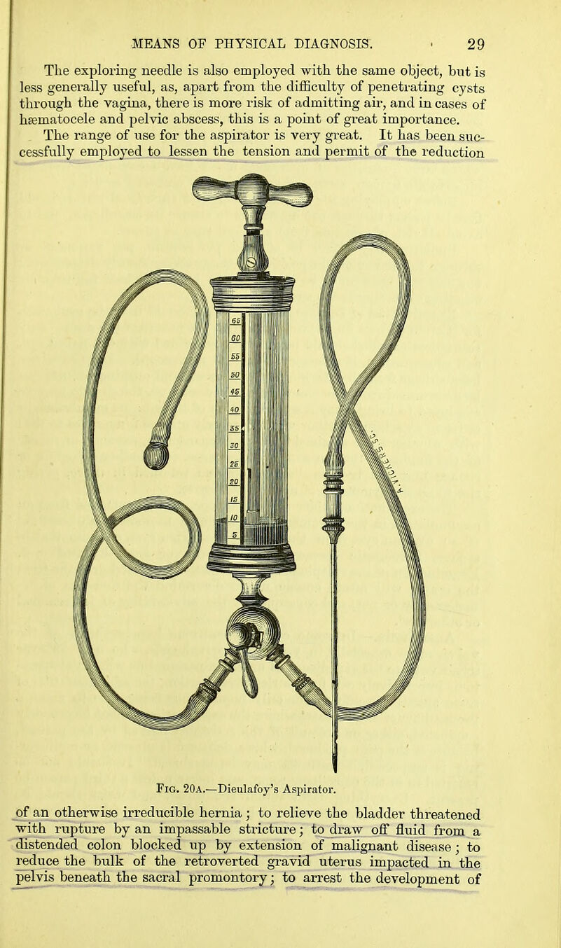 Tlie exploring needle is also employed with the same object, but is less generally useful, as, apart from the difficulty of penetrating cysts through the vagina, there is more risk of admitting air, and in cases of hsematocele and pelvic abscess, this is a point of great importance. The range of use for the aspirator is very great. It has been suc- cessfully employed to lessen the tension and permit of the reduction Fig. 20a.—Dieulafoy's Aspirator. of an otherwise irreducible hernia ; to relieve the bladder threatened with rupture by an impassable stricture; to draw off fluid from a (Estended colon blocked up by extension of malignant disease; to reduce the bulk of the retroverted gravid uterus impacted in the pelvis beneath the sacral promontory; to arrest the development of