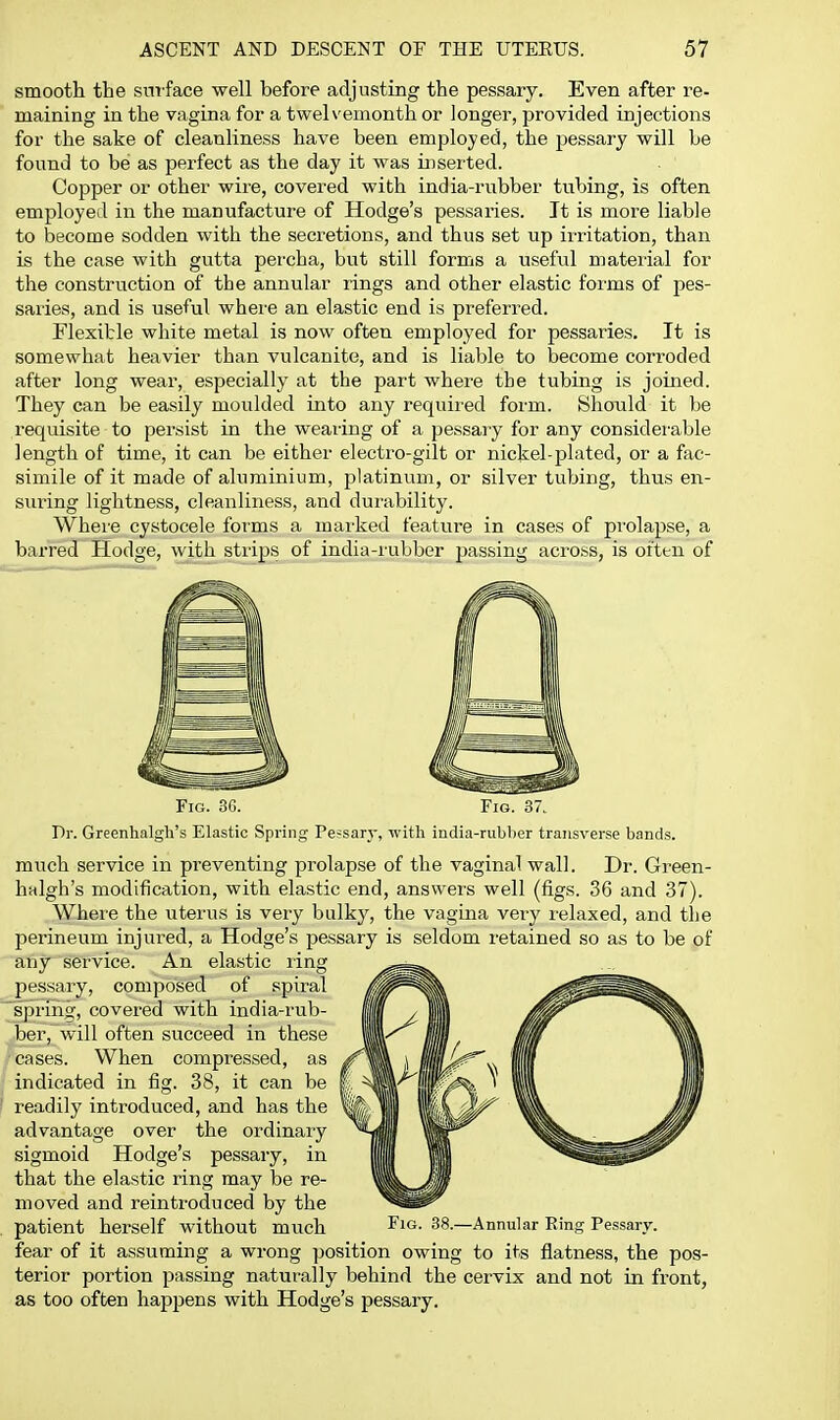 smooth the sm-face well before adjusting the pessary. Even after re- maining in the vagina for a twelvemonth or longer, provided injections for the sake of cleanliness have been employed, the pessary will be found to be as perfect as the day it was inserted. Copper or other wire, covered with india-rubber tubing, is often employed in the manufacture of Hodge's pessaries. It is more liable to become sodden with the secretions, and thus set up irritation, than is the case with gutta percha, but still forms a useful material for the construction of the annular rings and other elastic foims of pes- saries, and is useful where an elastic end is preferred. Flexible white metal is now often employed for pessaries. It is somewhat heavier than vulcanite, and is liable to become corroded after long wear, especially at the part where the tubing is joined. They can be easily moulded into any required form. Should it be requisite to persist in the wearing of a pessary for any considerable length of time, it can be either electro-gilt or nickel-plated, or a fac- simile of it made of aluminium, platinum, or silver tubing, thus en- suring lightness, cleanliness, and durability. Wheie cystocele forms a mai'ked feature in cases of pi'olapse, a barred Hodge, with strips of india-iubber passing across, is often of Fig. 3G. Fig. 37. Dr. Greenhalgh's Elastic Spring Pessary, with india-rubber transverse bands. much service in preventing prolapse of the vaginal wall. Di-. Green- halgh's modification, with elastic end, answers well (figs. 36 and 37). Where the uterus is very bulky, the vagina very relaxed, and the perineum injured, a Hodge's pessary is seldom retained so as to be of any service. An elastic ring pessary, composed of spiral spring, covered with india-rub- ber, will often succeed in these cases. When compressed, as indicated in fig. 38, it can be readily introduced, and has the advantage over the ordinary sigmoid Hodge's pessary, in that the elastic ring may be re- moved and reintroduced by the patient herself without much fear of it assuming a wrong position owing to its flatness, the pos- terior portion passing naturally behind the cervix and not in front, as too often happens with Hodge's pessary. Fig. 38.—Annular Ring Pessary.