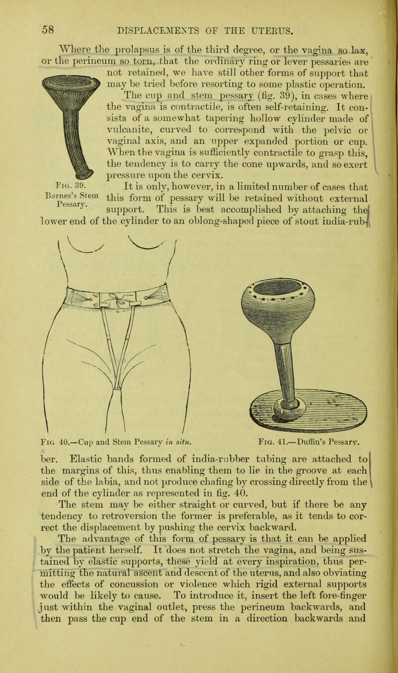 Wheie the jjrolapsns is of the third degiee, or the vagina so lax, or the perineum so torn, that the ordinary ring or lever pessai'ies ai-e not retained, we have still other forms of support that may be tried before resorting to some plastic opei-ation. The cup and stem pessary (fig. 39), in cases where the vagina is conti'actile, is often self-retaining. It con- sists of a somewhat tapering hollow cylinder made of vulcanite, curved to correspond with the pelvic of vaginal axis, and an upper expanded portion or cup. When the vagina is sufiiciently contractile to grasp this, the tendency is to carry the cone upwards, and so exert pressure upon the cervix. It is only, however, in a limited number of cases that this form of pessary will be retained without external support. This is best accomplished by attaching th lower end of the cylinder to an oblong-shaped piece of stout india-rub- Fig. 39. Barnes's Stem Pessary. Fig 40.—Cu|> and Stem Pessarv in situ. Fig. 41.— Diiliin's Pessarv. ber. Elastic bands formed of india-rubber tubing are attached to the margins of this, thus enabling them to lie in the groove at each side of the labia, and not produce chafing by crossing directly from the end of the cylinder as represented in fig. 40. The stem may be either straight or curved, but if there be any tendency to retroversion the former is preferable, as it tends to cor- rect the displacement by pushing the cervix backward. tThe advantage of this form of pessary is that it can be applied by the patient herself. It does not stretch the vagina, and being sus- tained by elastic supports, these yield at every inspii'ation, thus per- mitting the natural ascent and descent of the uterus, and also obviating the effects of concussion or violence which rigid external suppoi-ts would be likely to cause. To introduce it, insert the left fore-finger just within the vaginal outlet, press the perineum backwards, and then pass the cup end of the stem in a direction backwards and