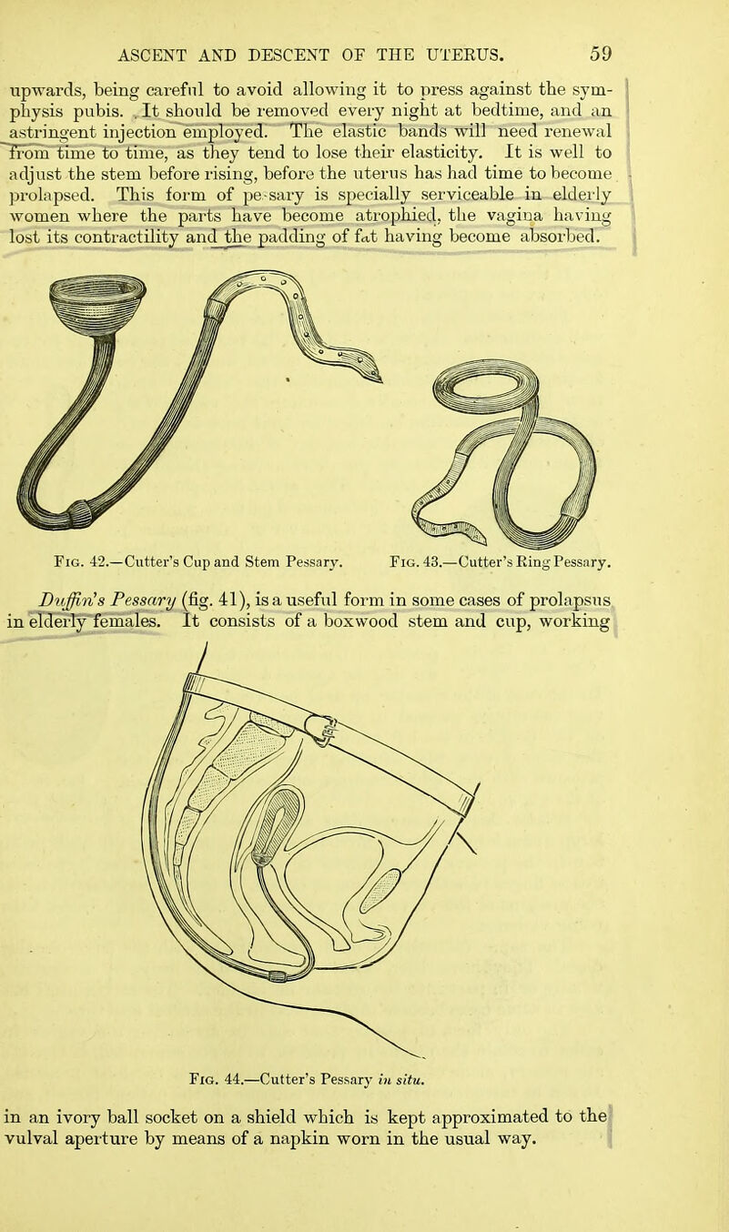 upwards, being careful to avoid allowing it to press against the sym- physis pubis. , It should be removed every night at bedtime, and an astringent injection eniployed! The elastic bands will need renewal iFom time to time, as they tend to lose their elasticity. It is well to adjust the stem before I'ising, before the uterus has had time to become prolapsed. This form of pe sary is specially serviceable in elderly women where the parts have become atrophied, tlie vagina having lost its contractility and the padding of fat having become absorbed. Fig. 42.—Cutter's Cup and Stem Pessary. Fig. 43.—Cutter's King Pessary. Bvffi.nls Pessary (fig. 41), is a useful form in some cases of prolapsus, in elderlyjemales. It consists of a boxwood stem and cup, working. Fig. 44.—Cutter's Pessary in situ. in an ivory ball socket on a shield which is kept approximated to the vulval aperture by means of a napkin worn in the usual way. j