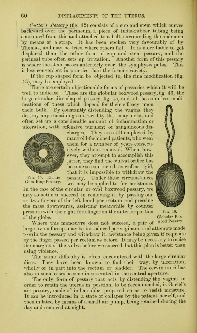 Cutter's Pessary (fig. 42) consists of a cup and stftm which curves backward over the perineum, a piece of india-rubber tubing being continued from this and attached to a belt surrounding the abdomen by means of a strap. It has been spoken very favourably of by Thomas, and may be tried where others fail. It is more liable to get displaced than the other form of cup and stem pessary, and the perineal tube often sets up irritation. Another form of this pessary is where the stem passes anterioi-ly over the symphysis pubis. This is less convenient in practice than the former variety. If the cup shaped form be objected to, the ring modification (fig. 43), may be employed. There ai'e certain objectionaljle forms of pessaries which it will be well to indicate. These are the globular boxwood pessary, fig. 46, the large circular disc-shaped pessary, fig. 4.5, and all the countless modi- fications of these which depend for their efiicacy upon their bulk. By constantly distending the vagina they destroy any remaining contractility that may exist, and often set up a considerable amount of inflammation or ulceration, with offensive purulent or sanguineous dis- charges. They are still employed by many old-fashioned patients, who wear them for a number of years consecu- tively without removal. When, how- ever, they attempt to accomplish this latter, they find the vulval orifice has become so contracted, as well as I'igid, that it is impo«=ilile to withdraw the pessary. Und hese circumstances we may be applied to for assistai In the case of the circular or oval boxwood pessary, may sometimes succeed in removing it, by passing one or two fingers of the left hand per rectum and pressing the mass downwards, assisting meanwhile by counter pressure with the right fore-finger on the anterior portion of the globe. Where this manoeuvre does not succeed, a pair of large ovum forceps may be introduced per vaginam, and attempts made to grip the pessary and withdraw it, assistance being given if requisite by the finger passed per rectum as before. It may be necessary to incise the margins of the vulva befoi'e we succeed, but this plan is better than using violence. The same difiiculty is often encountered with the large circular discs. They have been known to find their way, by ulceration, wholly or in part into the rectum or bladder. The cervix uteri has also in some cases become incarcerated in the central aperture. The only form of pessary that acts by distending the vagina in order to retain the uterus in position, to be recommended, is Grtriel's air pessary, made of india-rubber prepared so as to resist moisture. It can be introduced in a state of collapse by the patient heivself, and then inflated by means of a small air pump, being retained during the day and removed at night. Ftg. 45.—Kla'-tic Gum King Pessary. Fig. 46. Globular Box- wood Pessarv.