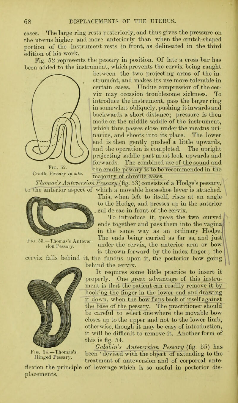 Fig. 52. Ciadle Pessarv in situ. cases. The large ring rests posteriorly, and thus gives the pressure on the uterus higher and mor? anteriorly than when the crutch-shajjed portion of the iusti'umep.t I'ests in front, as delineated in the thii'd edition of his work. Fig. 52 represents the pessary in position. Of late a cross har has been added to the instrument, which prevents the cervix being caught between the two projecting arms of the in- strument, and makes its use more tolerable in certain cases. Undue compression of the cer- vix may occasion troublesome sickness. To introduce the instrument, pass the larger ring in somewhat obliquely, pushing it inwards and bnckwards a short distance; pressure is then made on the middle saddle of the instrument, which thus passes close under the meatus uri- n;irius, and shoots into its place. The lower end is then gently pushed a little upwards, and the operation is completed. The upright projecting saddle part must look upwards and forwards. The combined use of the sound and the cradle pessary is to be recommended in the majority of chronic cases. Thomas's Anteversion Pessary (fig. 53) consists of a Hodge's pessary, to the anterior aspecc of which a movable horseshoe lever is attached. This, when left to itself, rises at an angle to the Hodge, and presses up in the anterior , cul-de-sac in front of the cei-vix. To introduce it, press the two curved^' ends together and pass them into the vaginal in the same way as an ordinary Hodge.| The ends being carried as far as, and just\ under the cervix, the anterior arm or bow \ is thrown forwai'd by the index finger ; the I it, the fundus upon it, the posterior bow going behind the cervix. It requires some little practice to insert it properly. One gi'eat advantage of this instru- ment is that the patient can readily remove it by hook'ng the finger in the lower end and drawing it down, when the bow flaps back of itself against the liase of the pessary. The practitioner should be cai-eful to select one where the movable bow closes up to the upper and not to the lower limb, otherwise, though it may be easy of introduction, it will be difficult to remove it. Another form of this is fig. 54. Gdlahiris Anteversion Pessary (fig. 55) has been 'devised with the object of extending to the trentment of anteversion and of corpoieal ante- flexion the principle of leverage which is so useful in posterior dis- placements. Fig. 53.—Thomas'.s Antever- sion Pessarv. cer\ax falls behind l''iG. 54.—Thomas's Hined Pessarv.