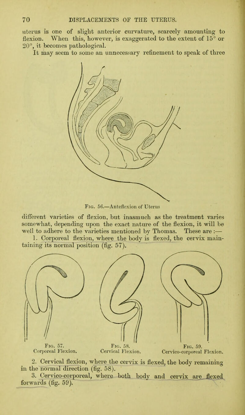 uterus is one of slight anterior curvature, scarcely amounting to flexion. When this, however, is exaggerated to the extent of 15° or 20°, it becomes pathological. It may seem to some an unneces!^ary refinement to speak of three Fig. 56.—Anteflexion of Uterus different varieties of flexion, but inasmuch as the treatment varies somewhat, depending upon the exact nature of the flexion, it will be well to adhere to the varieties mentioned by Thomas. These are :— 1. Corporeal flexion, where the body is flexed, the cervix main- taining its normal position (fig. 57). Fig. 57. Fig. 58. Fig. 59. Corporeal Flexion. Cervic.il Flexion. Cervico-corporeal Flexion. 2. Cervical flexion, where the cervix is flexed, the body remaining in the normal direction (fig. 58). 3. Cervico-corporeal, where both body and cervix are_ilexed forwards (fig. 59). ~ •