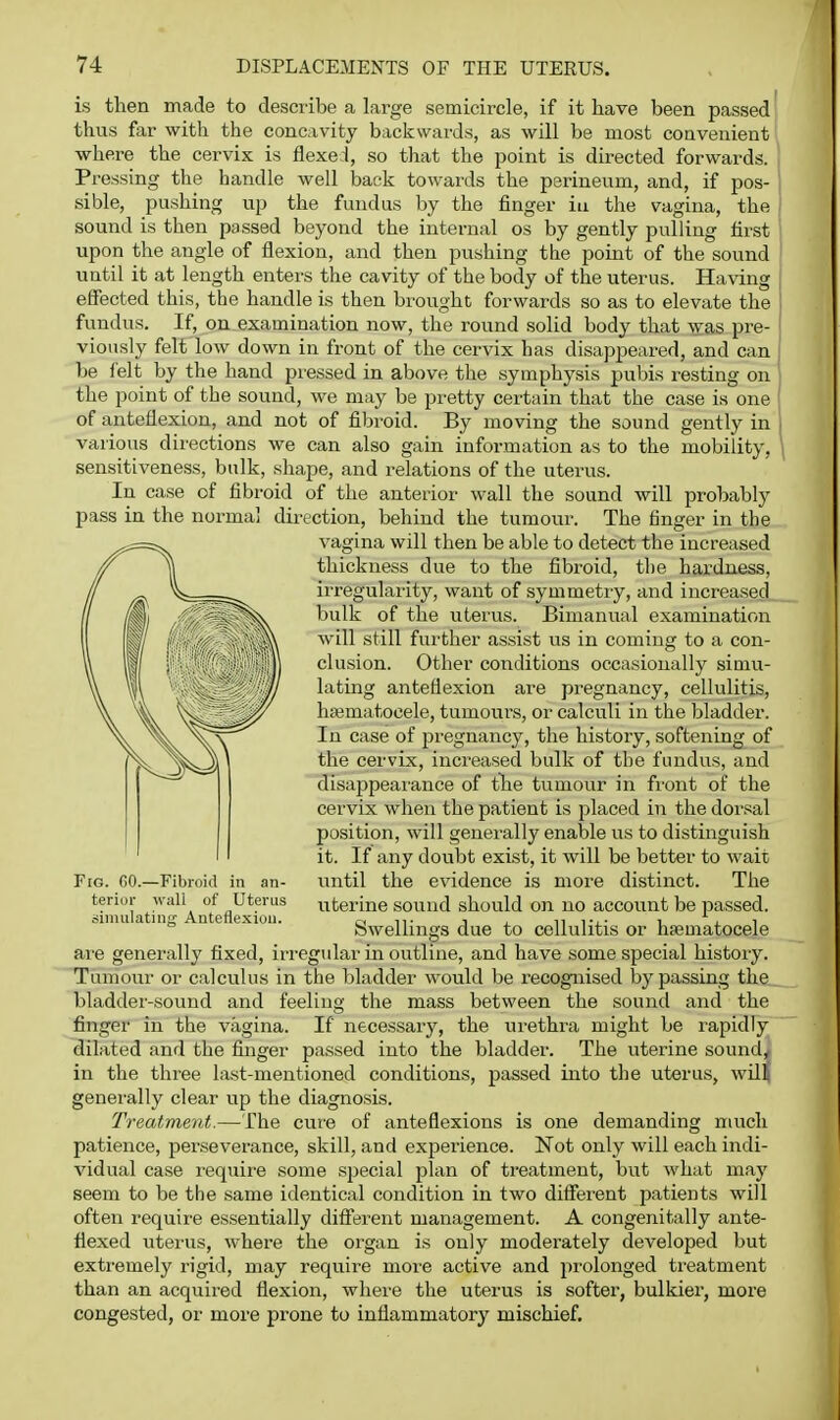 mobility, probably is then made to describe a large semicircle, if it have been passed thus far with the concavity backwards, as will be most convenient where the cervix is flexed, so that the point is directed forwards. Pressing the handle well back towards the perineum, and, if pos- sible, pushing up the fundus by the finger in the vagina, the sound is then passed beyond the internal os by gently pulling first upon the angle of flexion, and then pushing the point of the sound until it at length enters the cavity of the body of the uterus. Having effected this, the handle is then brought forwards so as to elevate the fundus. If, on examination now, the round solid body that was pre- viously felt low down in front of the cervix has disappeared, and can be I'elt by the hand piessed in above the symphysis pubis resting on the point of the sound, we may be pretty certain that the case is one of anteflexion, and not of fibroid. By moving the sound gently in various dii'ections we can also gain information as to the sensitiveness, bulk, shape, and relations of the uterus. In case of fibroid of the anterior wall the sound will pass in the normal direction, behind the tumour. The finger in the vagina will then be able to detect the increased thickness due to the fibroid, the hardness, irregularity, want of symmetry, and increased bulk of the uterus. Bimanual examination will still further assist us in coming to a con- clusion. Other conditions occasionally simu- lating anteflexion are pregnancy, cellulitis, ha^matocele, tumours, or calculi in the bladder. In case of j^regnancy, the history, softening of the cervix, increased bulk of the fundus, and disappearance of tlae tumour in front of the cervix when the patient is placed in the dorsal position, will generally enable us to distinguish it. If any doubt exist, it will be better to wait until the evidence is more distinct. The uterine sound should on no account be passed. Swellings due to cellulitis or hfematocele are generally fixed, irregular in outline, and have some special history. Tumour or calculus in the bladder would be recognised bypassing the bladder-sound and feeling the mass between the sound and the finger in the vagina. If necessary, the urethra might be rapidly dilated and the finger passed into the bladder. The uterine sound, in the three last-mentioned conditions, passed into the uterus, wUl generally clear up the diagnosis. Treatment.—The cure of anteflexions is one demanding much patience, perseverance, skill, and experience. Not only will each indi- vidual case require some special plan of treatment, but what may seem to be the same identical condition in two difierent patients will often require essentially difi'erent management. A congenitally ante- flexed uterus, where the organ is only moderately developed but exti-emely rigid, may require more active and prolonged treatment than an acquired flexion, where the uterus is softer, bulkier, more congested, or more prone to inflammatory mischief. Fig. CO.—Fibroid in an- terior wall of Uterus simiilatinir Anteflexiou.
