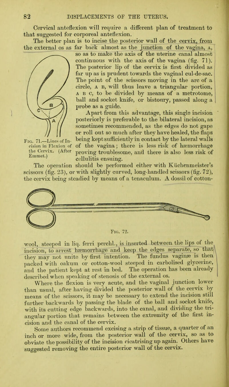 Cervical anteflexion will require a different plan of treatment to that suggested for corporeal anteflexion. The better plan is to incise the posterior wall of the cervix, from the external os as far back almost as the junction of the vagina, a, so as to make the axis of the uterine canal almost continuous with the axis of the vagina (fig. 71). The posteiior lip of the cervix is first divided as far up as is prudent towards the vaginal cul-de-sac. The point of the scissors moving in the arc of a circle, A B, will thus leave a triangular portion, A B c, to be divided by means of a metrotome, ball and socket knife, or bistoury, passed along a probe as a guide. Apart from this advantage, this single incision posteriorly is jjreferable to the bilateral incision, as sometimes recommended, as the edges do not gape or roll out so much after they have healed, the flaps being kept sufficiently in contact by the lateral walls of the vagina; there is less risk of hfemori'hage tlie Cervix. (After proving troublesome, and there is also less risk of Emmet. . ' ' cellulitis ensuing. The operation should be performed either with Kiichenmeister's scissors (fig. 23), or with slightly curved, long-handled scissors (fig. 72), the cervix being steadied by means of a tenaculum. A dossil of cotton- FiG. 71.—Lines of In- oision in Flexion of Fig. 72. wool, steeped in Hq. ferri perchl., is inserted between the lips of the incision, to arrest hremorrhage and keep the edges separate, .so that, they may not unite by first intention. The fundus vaginfe is then packed with oakum or cotton-wool steeped in carbolised glycerine, and the patient kept at rest in bed. The operation has been already described when speaking of stenosis of the external os. Where the flexion is very acute, and the vaginal junction lower than usual, after having divided the posterior wall of the cervix by means of the scissors, it may be necessary to extend the incision still further backwards by passing the blade of the ball and socket knife, with its cutting edge backwards, into the canal, and dividing the tri- angular portion that remains between the extremity of the first in- cision and the canal of the cervix. Some authors recommend excising a strip of tissue, a quarter of an inch or more wide, from the posterior wall of the cervix, so as to obviate the possibility of the incision cicatrising up again. Others have suggested removing the entire posterior wall of the cervix.