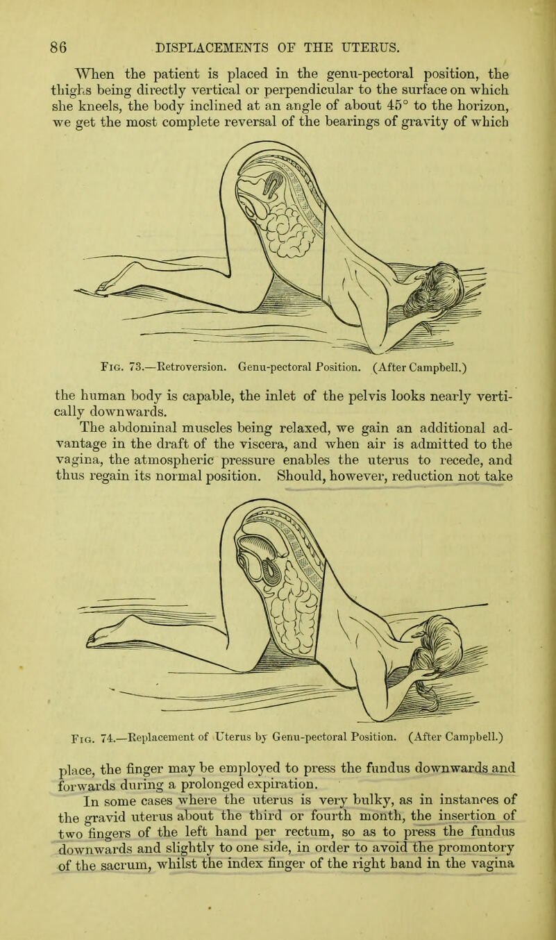 When the patient is placed in the genii-pectoi'al position, the thighs being directly vertical or perpendicular to the surface on which she kneels, the body inclined at an angle of about 45° to the horizon, we get the most complete reversal of the bearings of gravity of which Fig. 73.—Retroversion. Genu-pectoral Position. (After Campbell.) the human body is capable, the inlet of the pelvis looks nearly verti- cally downwards. The abdominal muscles being relaxed, we gain an additional ad- vantage in the draft of the viscera, and when air is admitted to the vagina, the atmospheric pressure enables the uterus to recede, and thus regain its normal position. Should, however, reduction not take Fio. 74.—Replacement of Uterus by Genu-pectoral Position. (After Campbell.) place, the finger may be employed to press the fundus downwards and forwards during a prolonged expiration. In some cases where the uterus is very brtlky, as in instances of the gravid \iterus about the third or fourth month, the insertion of two fingers of the left hand per rectum, so as to press the fundus downwai'ds and slightly to one side, in order to avoid the promontory of the sacrum, whilst the index finger of the right band in the vagina