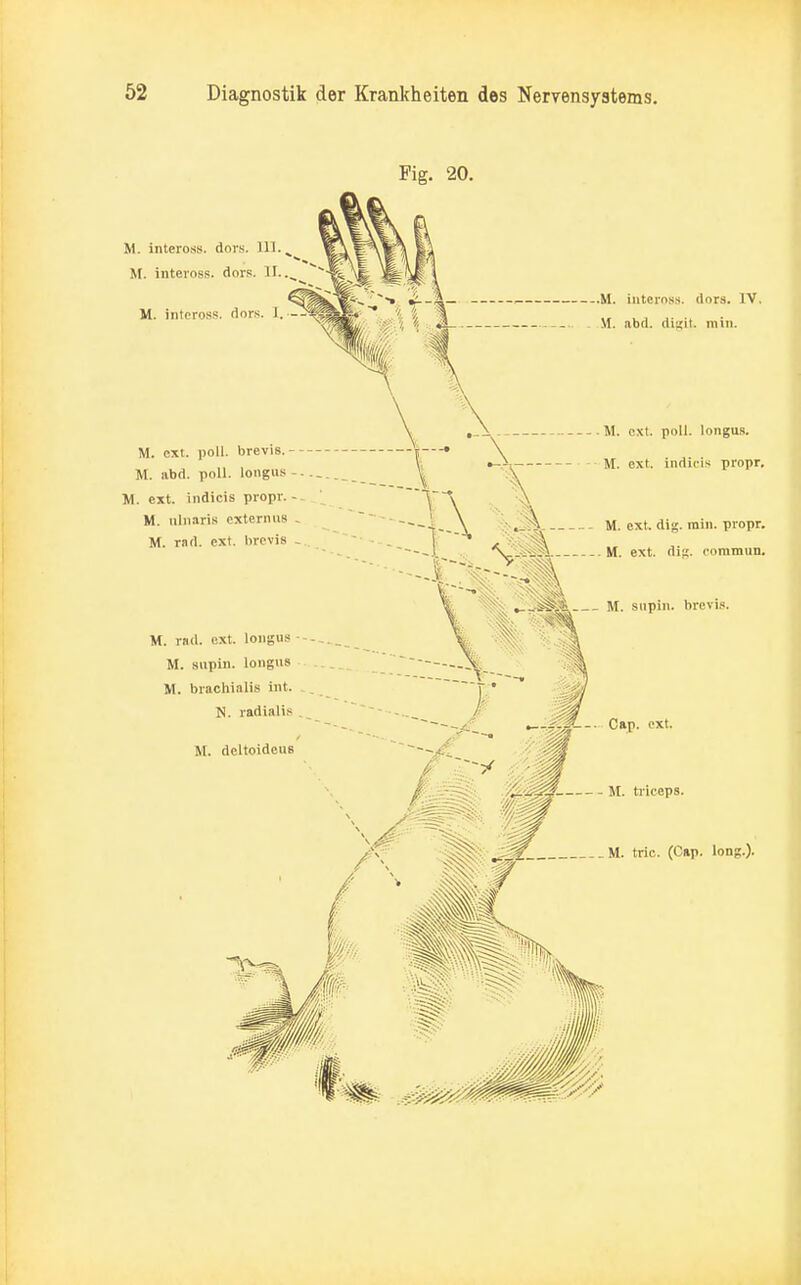 Fig. 20. M. inteross. dors. III. M. inteross. dors. II.. M. inteross. dors. I. - .M. inteross. dors. IV. M. abd. di^it. min. M. ext. poll. longus. M. ext. poll. brevis.-- * • \ „ , V •-.? M. ext. indiris propr. M. abd. poll. longus - M. ext. indicis propr. - ^ \ M. tdJiaris extemus -  1 \ JiL M. ext. dig. min. propr. M. rad. ext. brevis ... -■ . .  x'^feSsk ---.) 'V.-^Ji. M. ext. di«. «•ommuii. ^_ä#i4 M. supin. brevis. M. rad. ext. longus-- V || M. supin. longa« M. brachialis int. j • , N. radialis . - . / Cap. ext. M. dcltoidens , jjjg /^ääi§. M. trieeps.