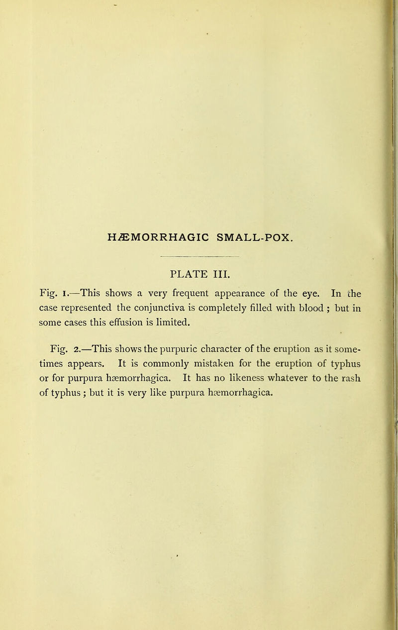 PLATE III. Fig. i.—This shows a very frequent appearance of the eye. In the case represented the conjunctiva is completely filled with blood ; but in some cases this effusion is limited. Fig. 2.—This shows the purpuric character of the eruption as it some- times appears. It is commonly mistaken for the eruption of typhus or for purpura hemorrhagica. It has no likeness whatever to the rash of typhus ; but it is very like purpura hemorrhagica.